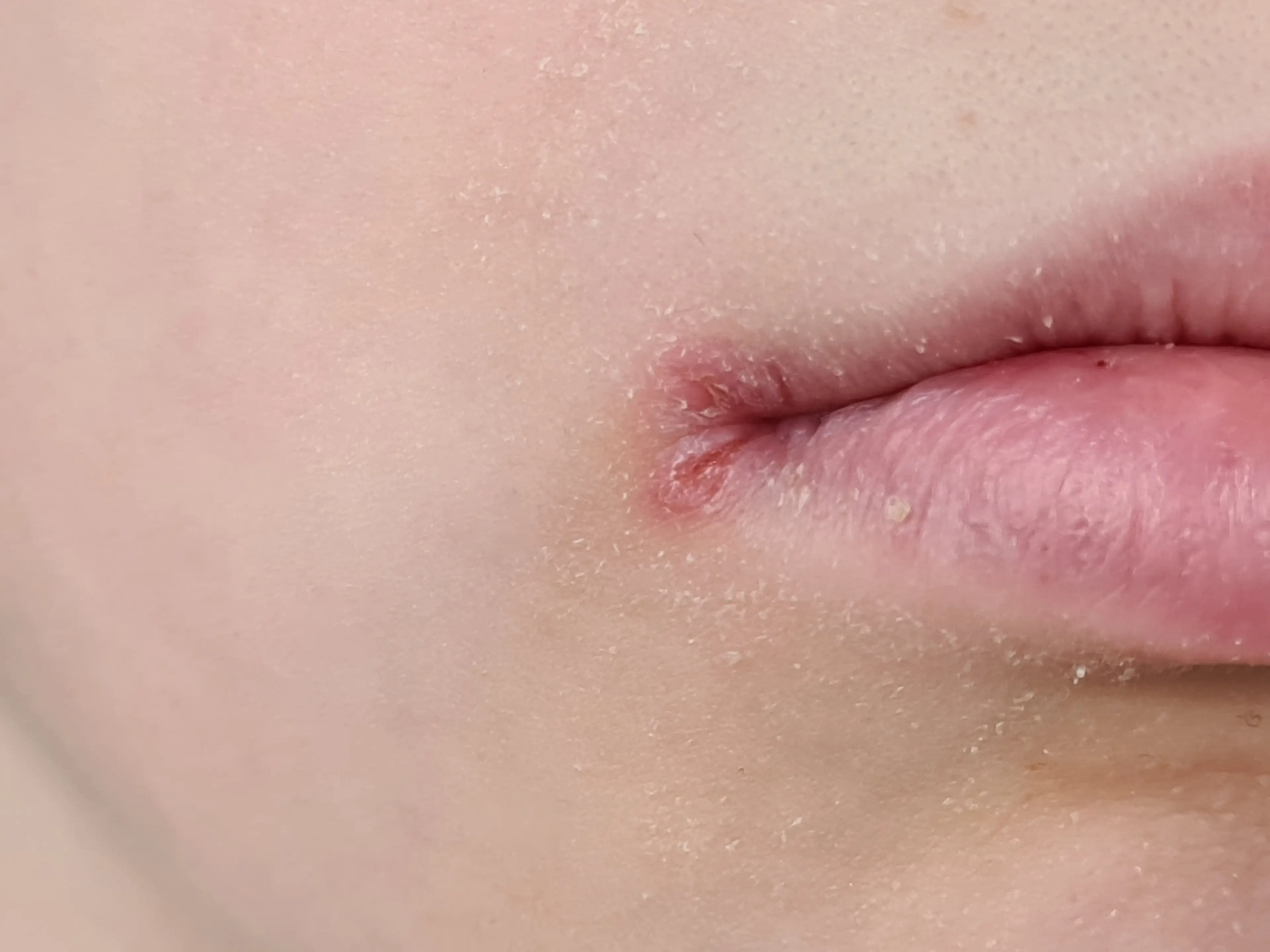 The dentist warned of a more serious underlying problem behind ‘chapped lips’ (Getty Stock Image)