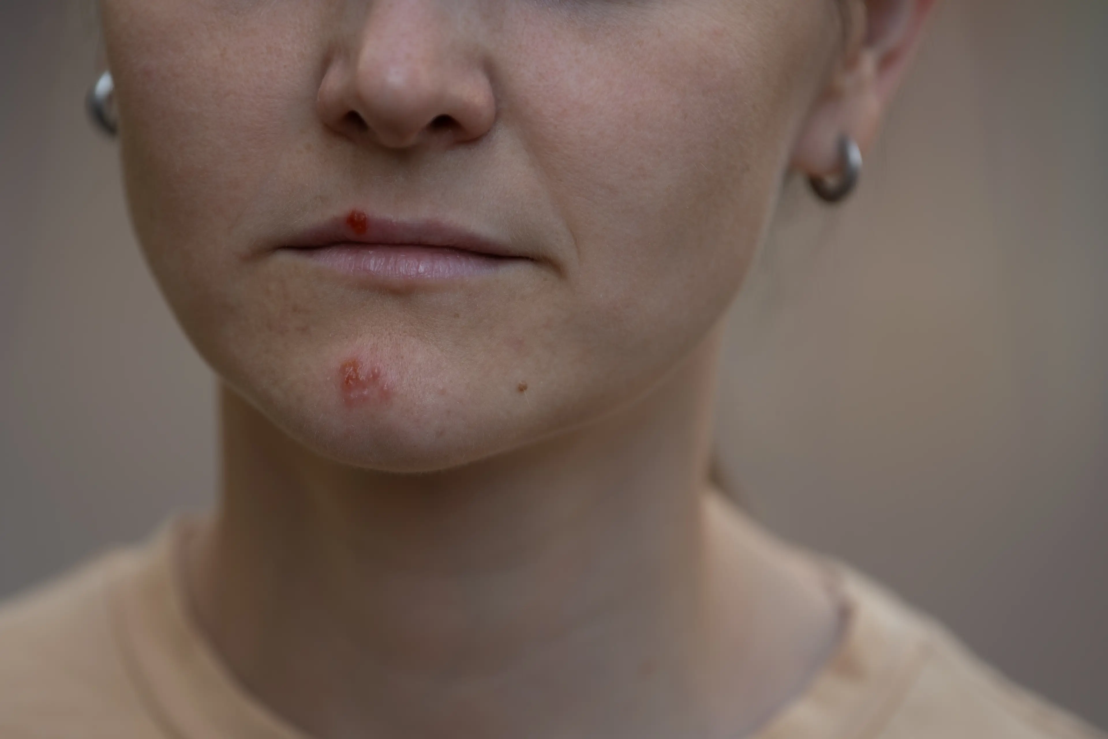 Beards can harbour bacteria which can then be transferred through breaks in the skin, and lead to skin issues like impetigo (Getty stock image)