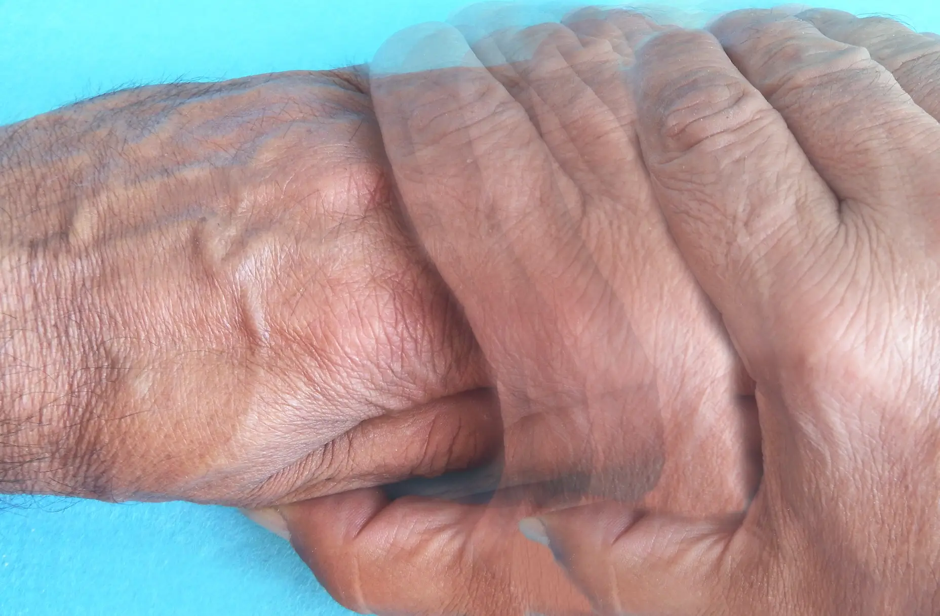 Use of the hands can be impacted by Parkinson's (Getty Stock Images)