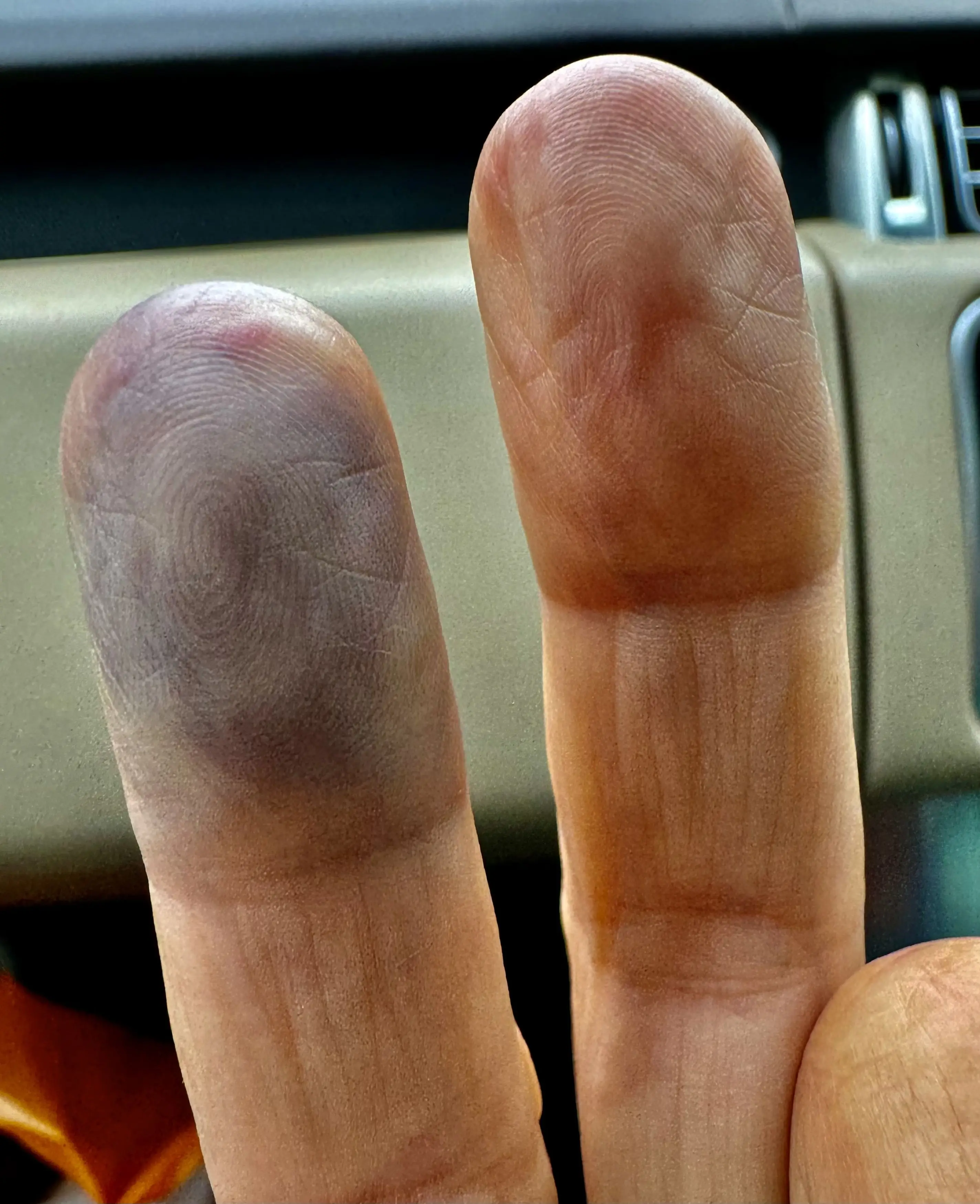 The 'faulty' armrest 'collapsed' on her finger. (Kennedy News and Media)