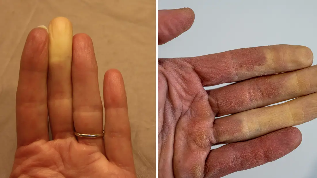 What it actually means if one of your fingers turns white when it’s cold