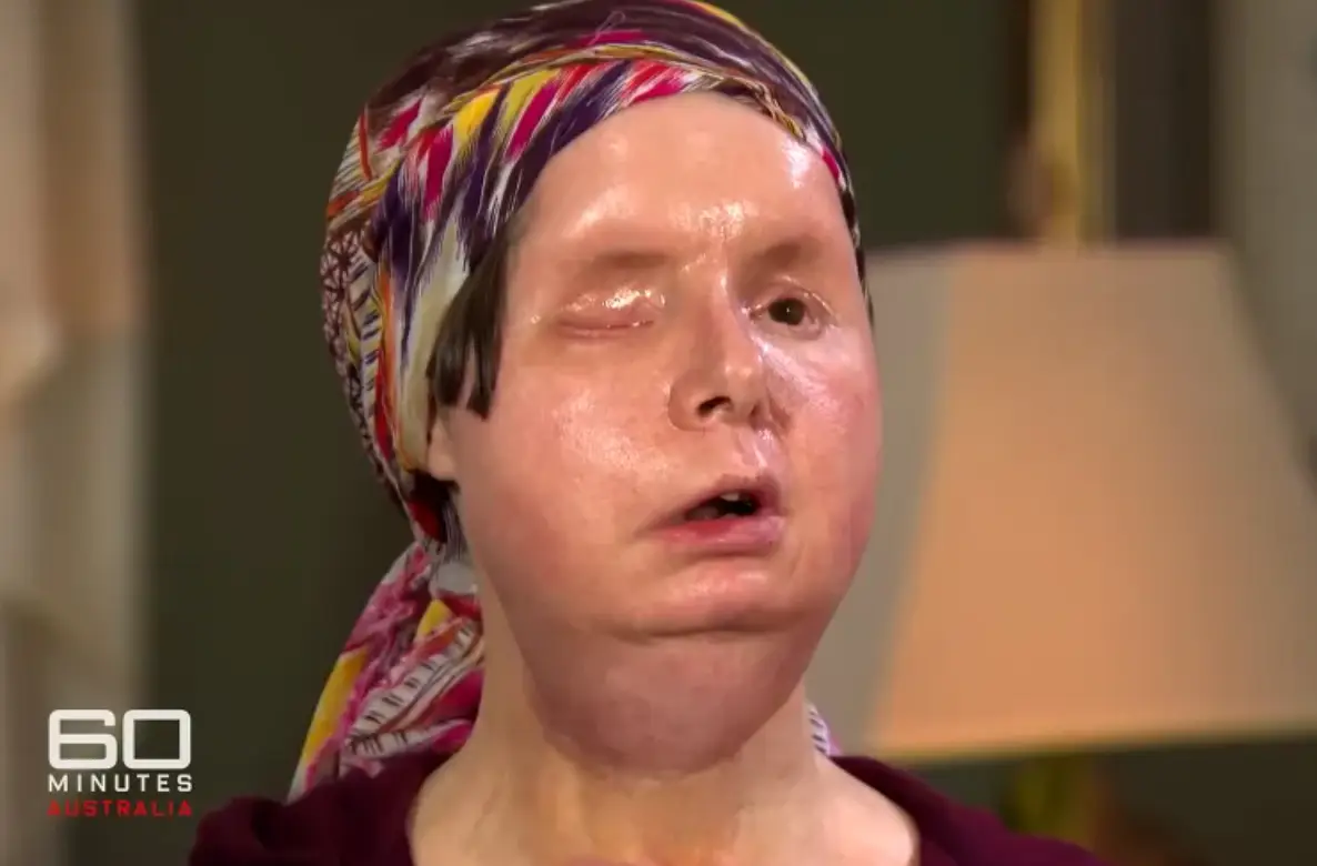 Charla Nash has revealed how her face transplant saved her life after she was brutally attacked by her friend's chimpanzee back in 2009 (60 Minutes Australia)
