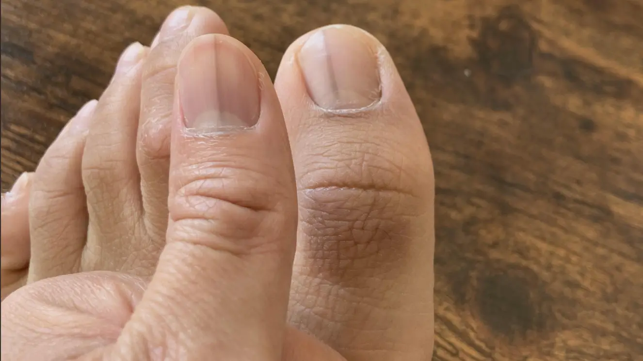 Woman urged to see doctor after toe photo reveals potentially life-threatening condition