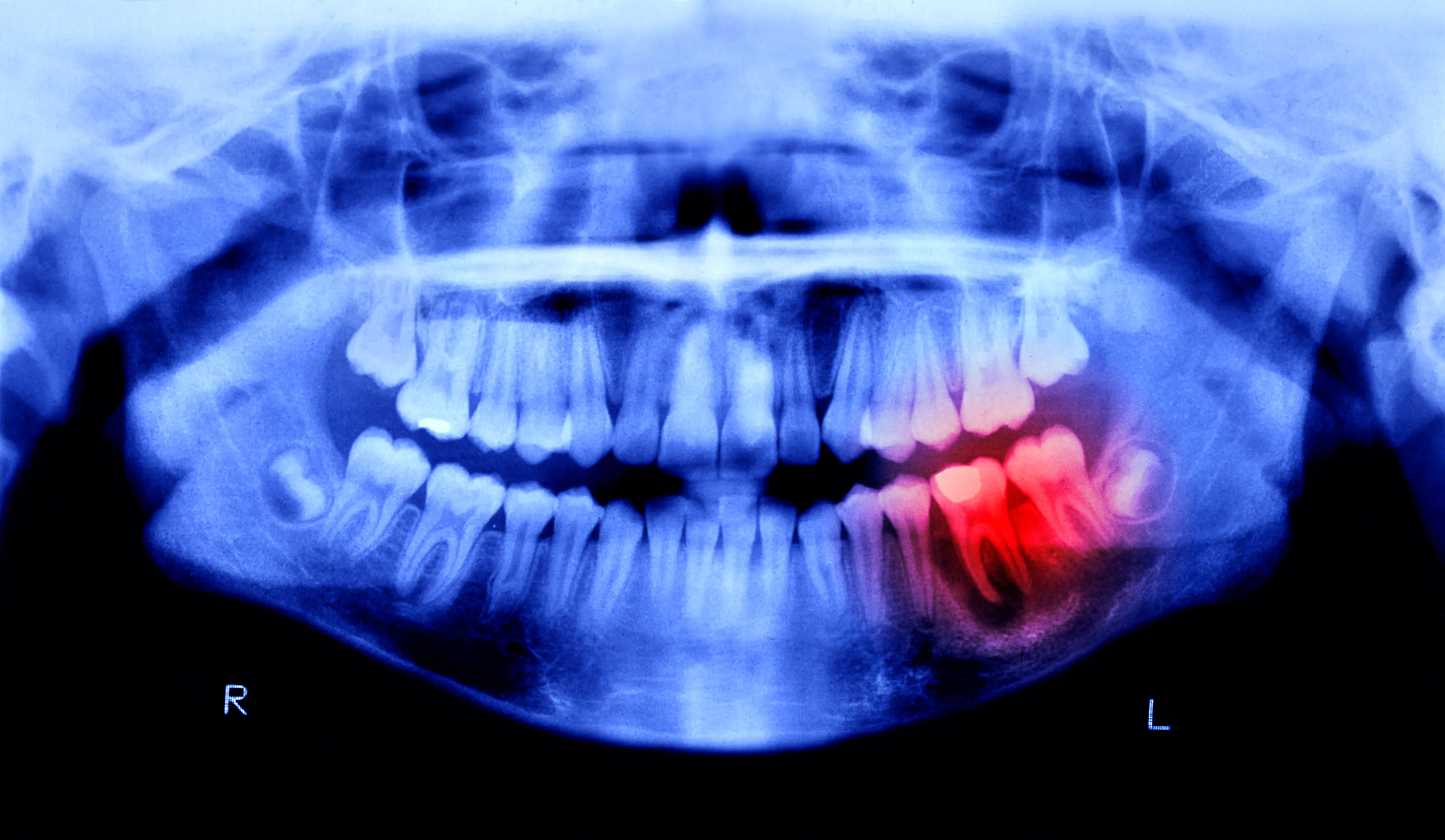Could gum disease be linked to Alzheimer's (Peter Dazeley/Getty)