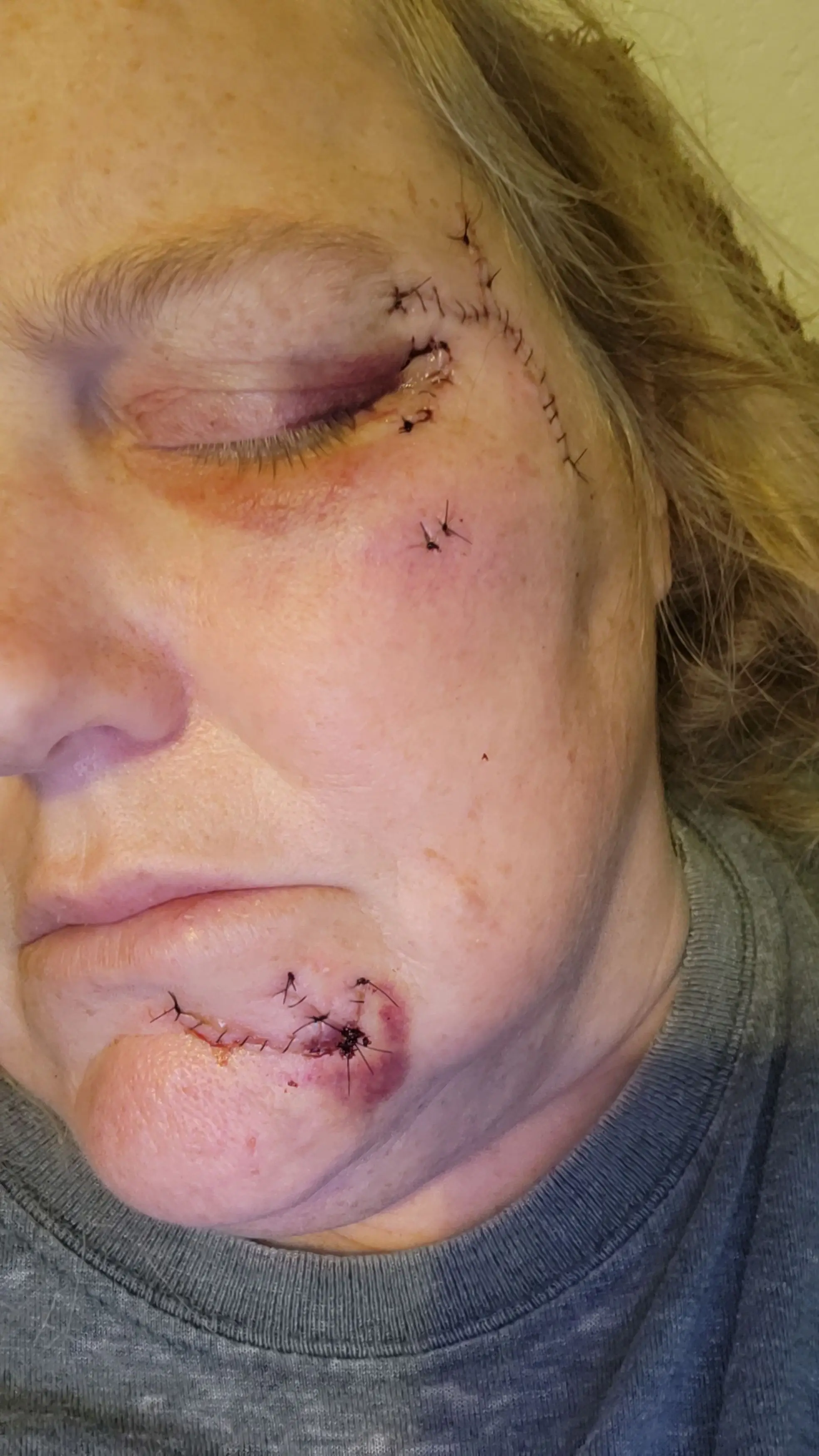 Rhonda the scars she sustained may be permanent.