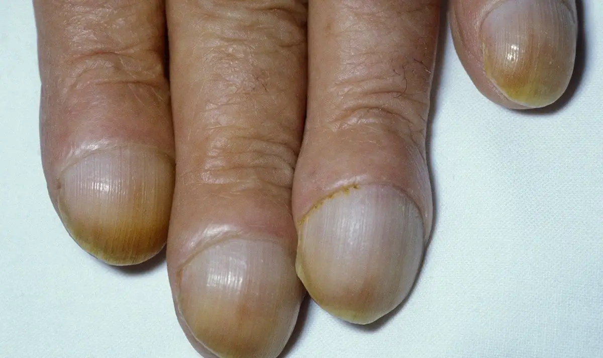 Clubbed fingers could be a sign of an underlying health issue (NHS)