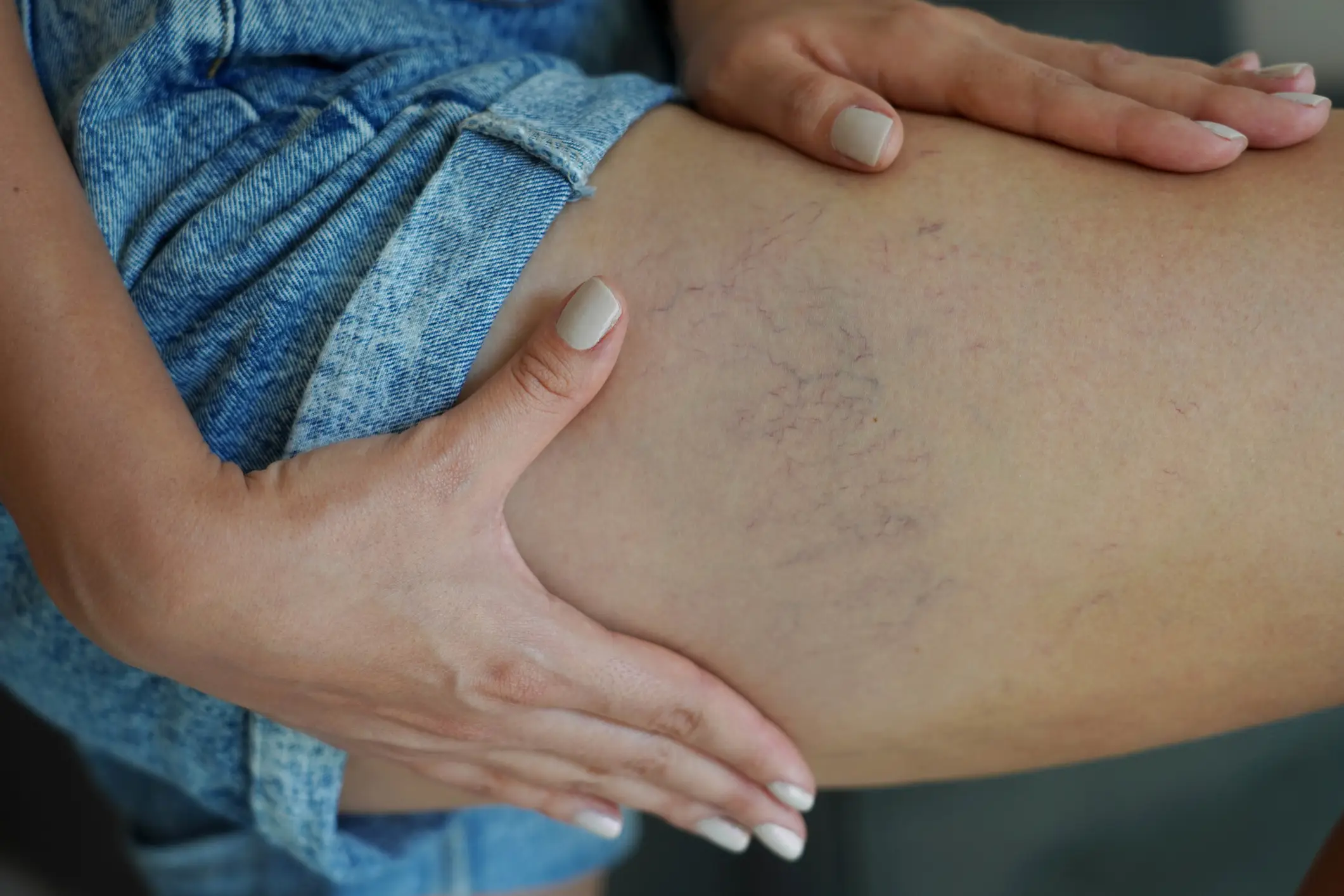 Spider veins can also be caused by genetics or lifestyle (Getty Stock)