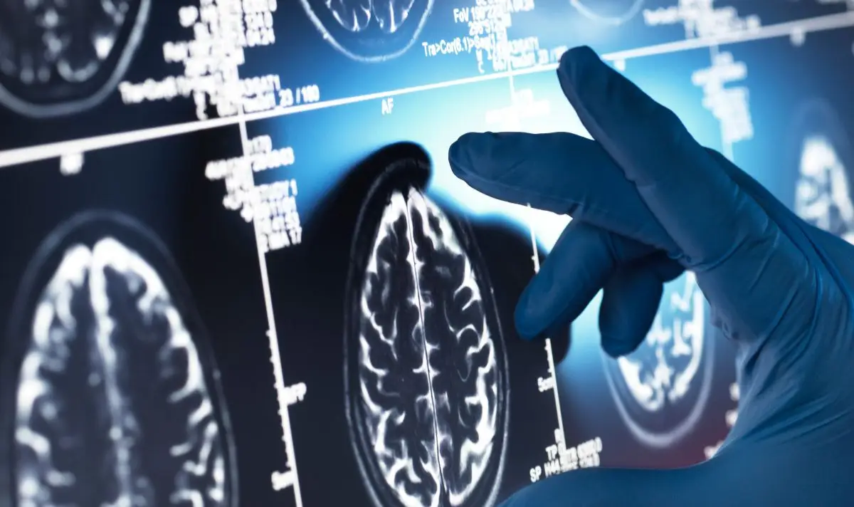 Young people have been warned to get a diagnosis early (Getty Stock Image)