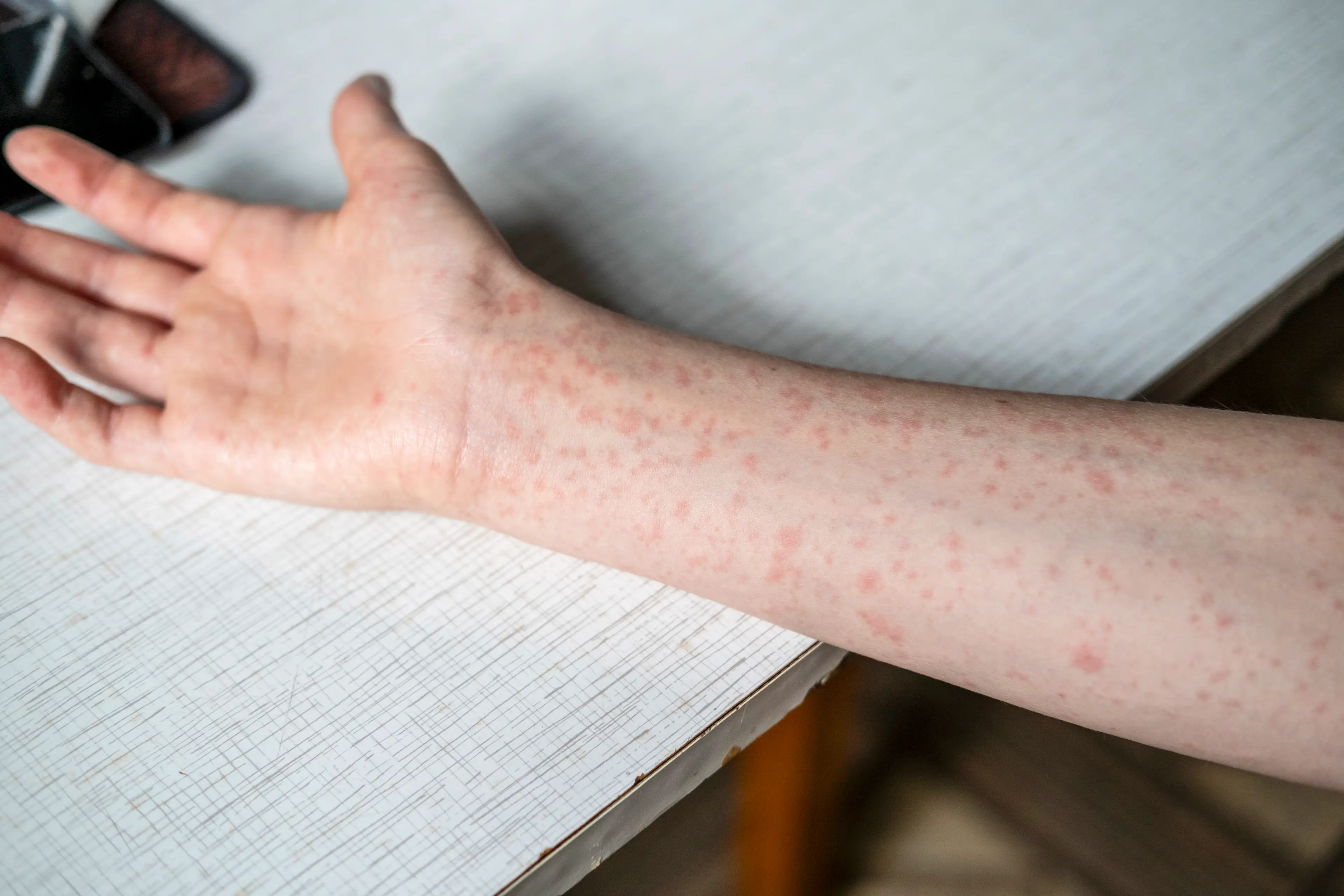 One of the most well-known symptoms of measles is a distinctive rash (Natalya Maisheva/Getty Images)