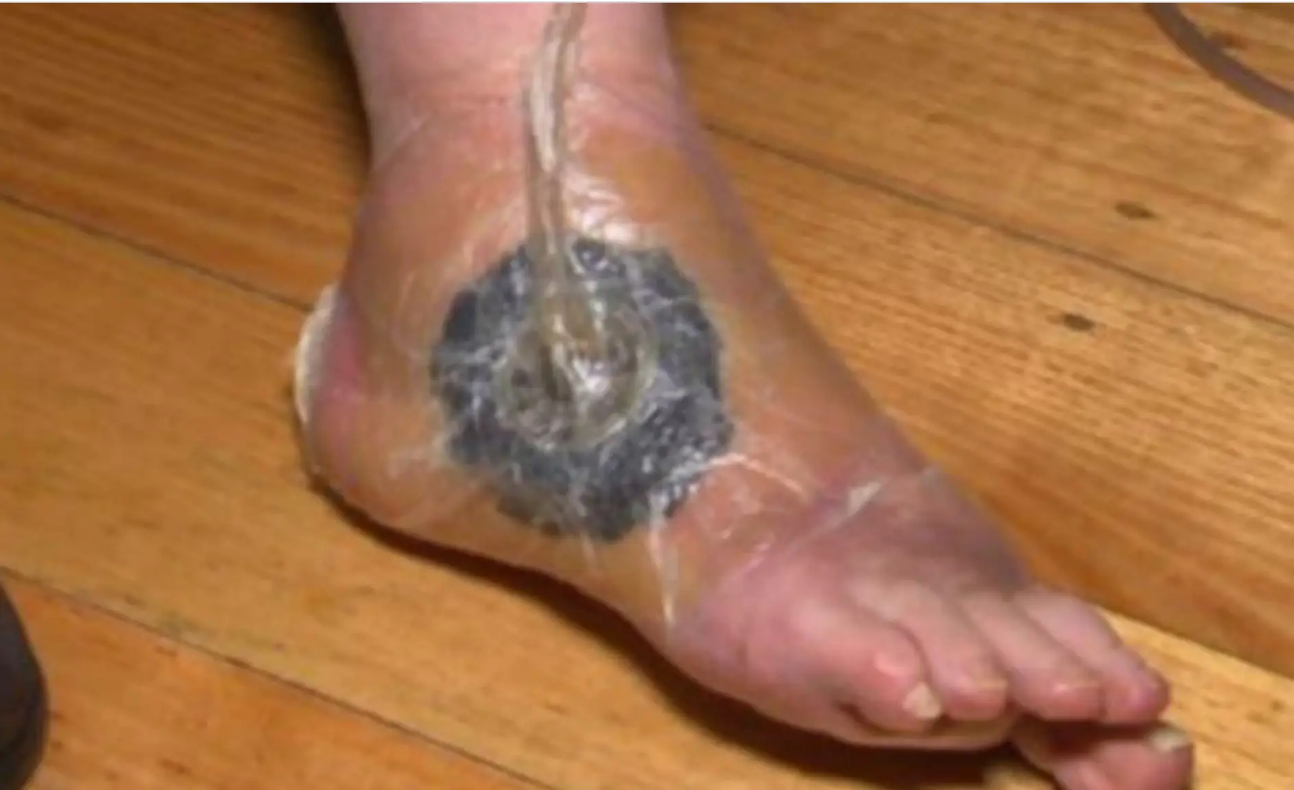 It’s unclear how the infection is spread.