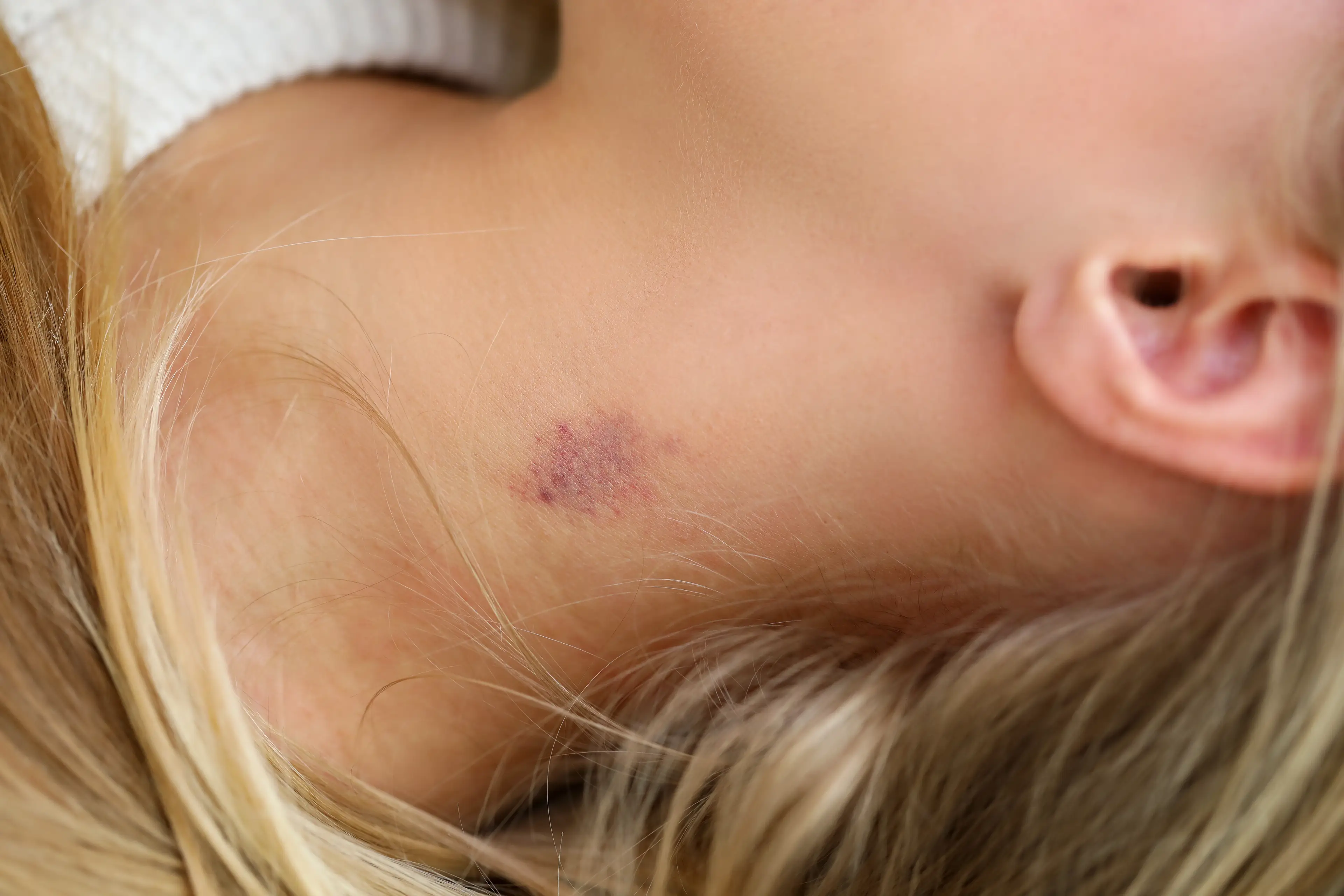 There are rare cases where a hickey could lead to a stroke (Getty Stock Images)