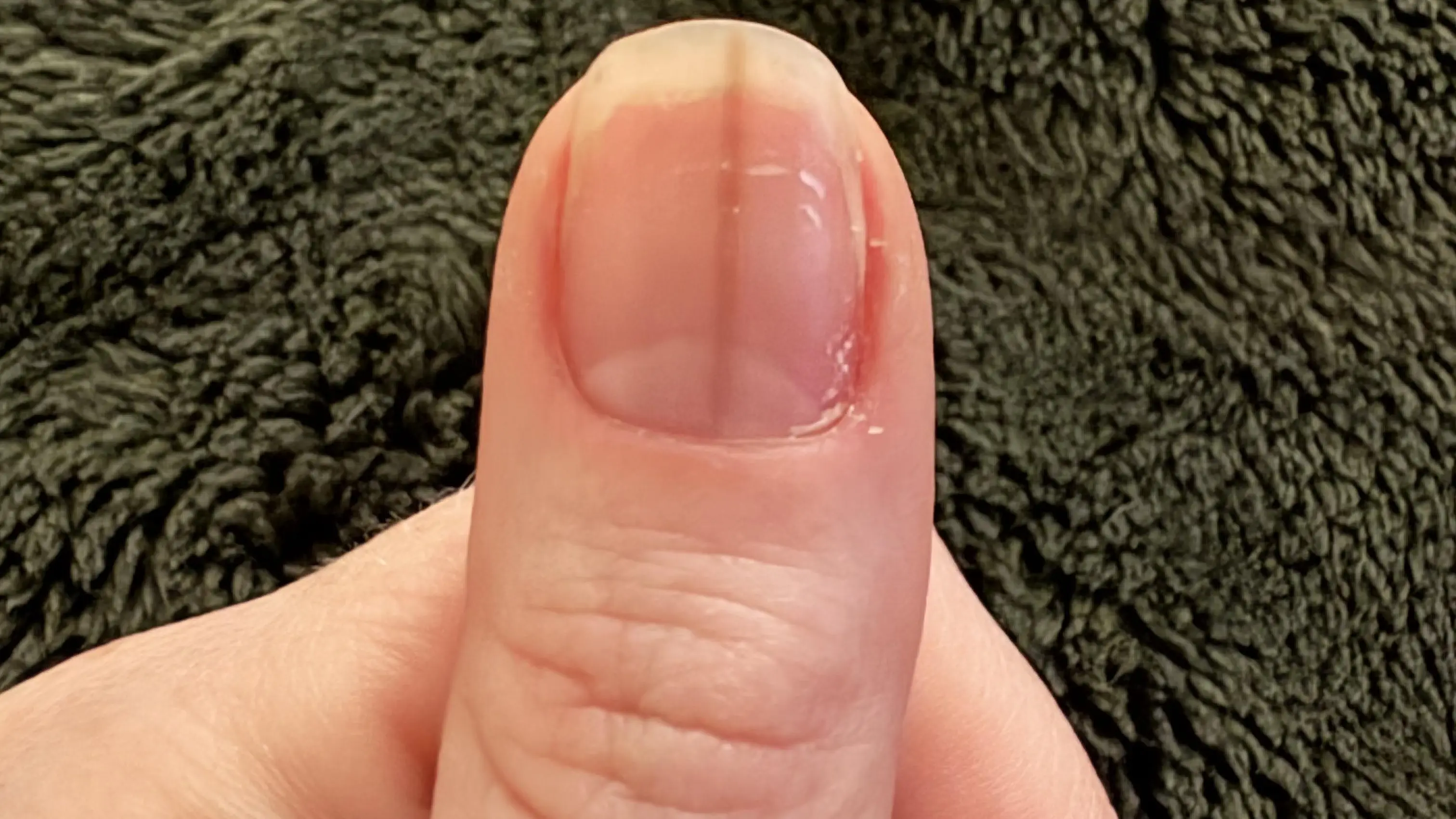 Woman told to see doctor immediately after sharing image of her thumb online