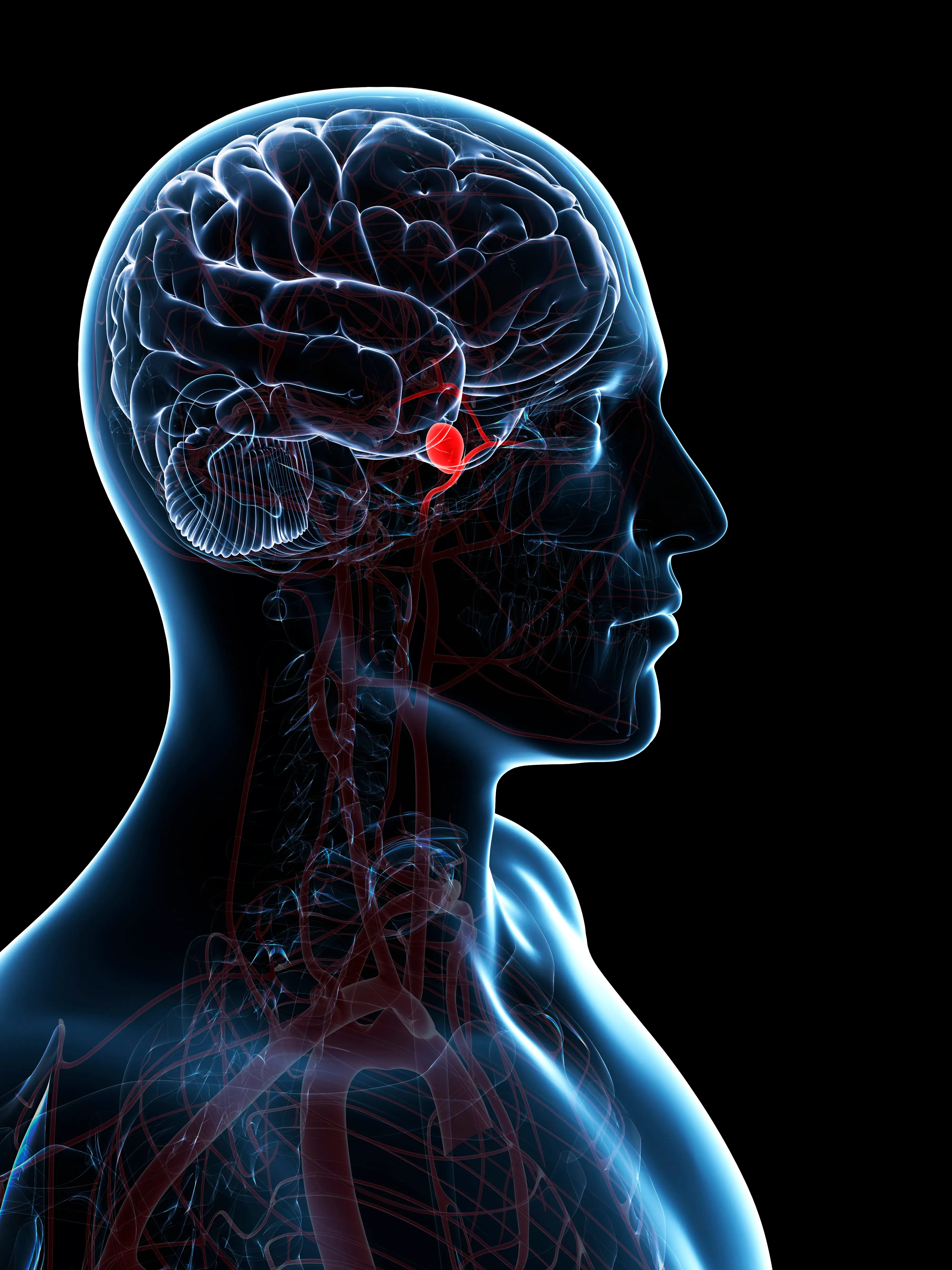 An aneurysm is a swelling in the brain (Getty Stock Image)