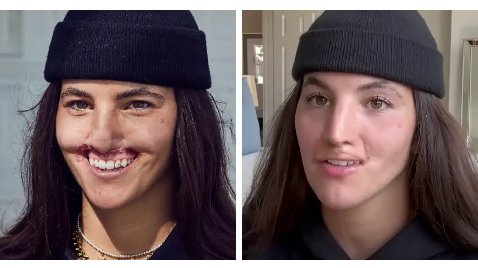 Woman whose lip was ripped off by pit bull shows off results of last surgery