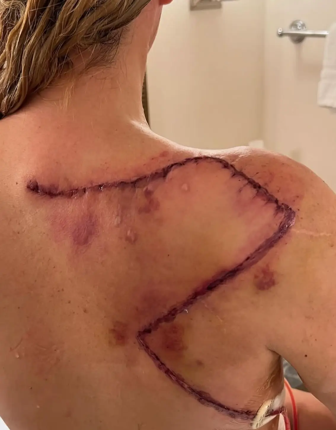 The TV star was given the all-clear on melanoma in December 2024 after as many as 20 surgeries (Instagram/@teddimellencamp)