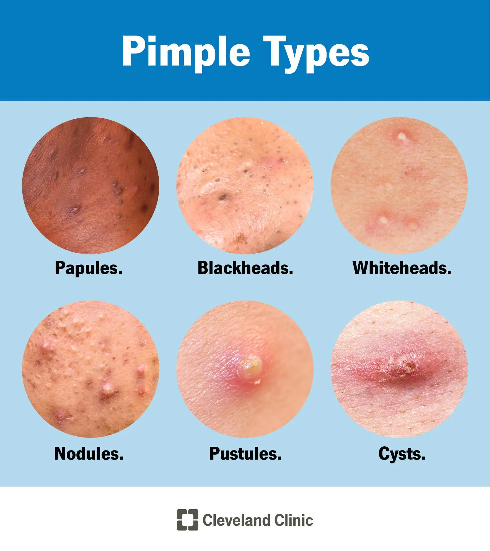 Acne can come in many different forms (Cleveland Clinic)
