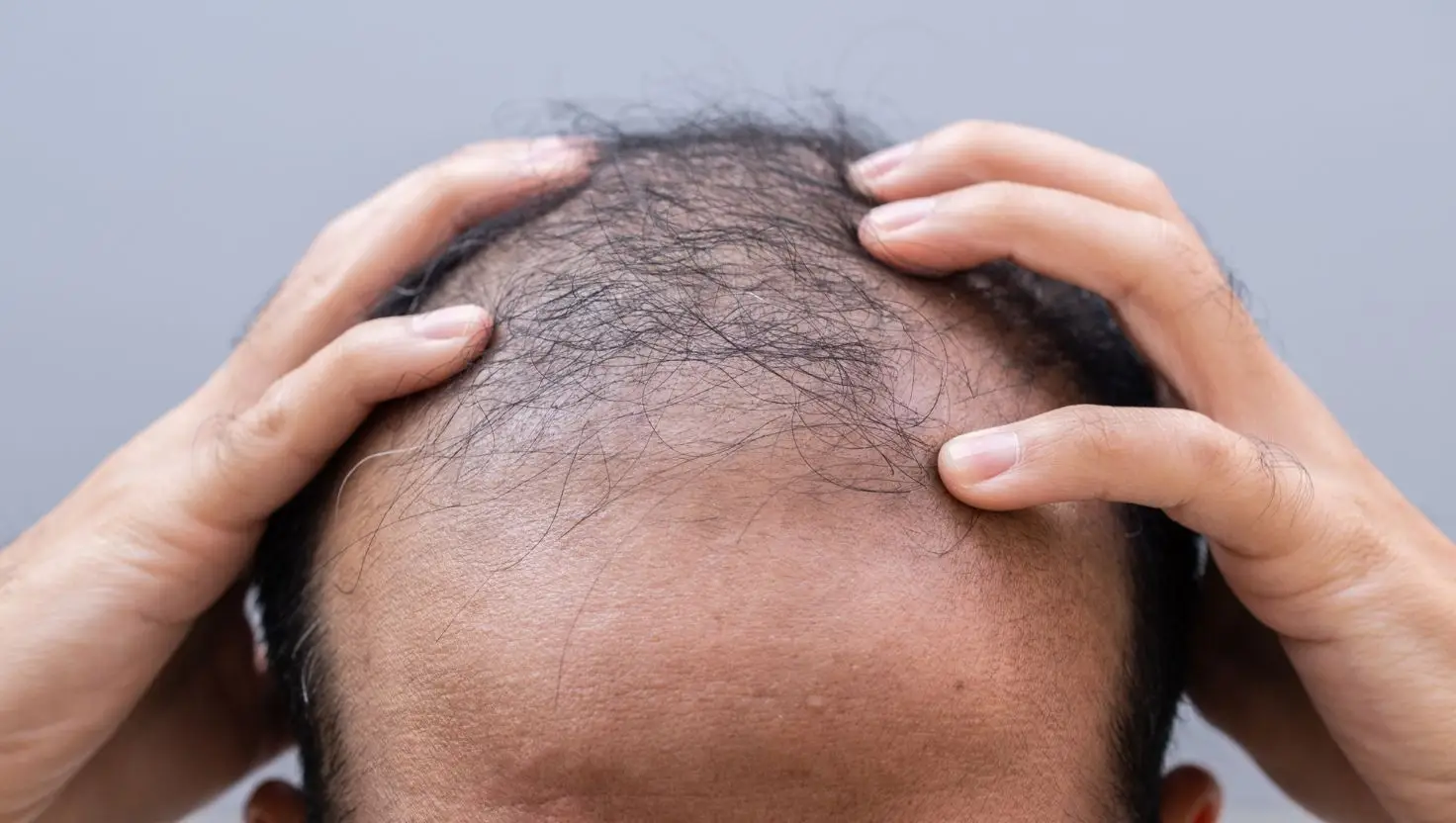 Your relatives and your family photo albums could hold the answer to whether or not you will go bald in the future (Getty Stock Image)