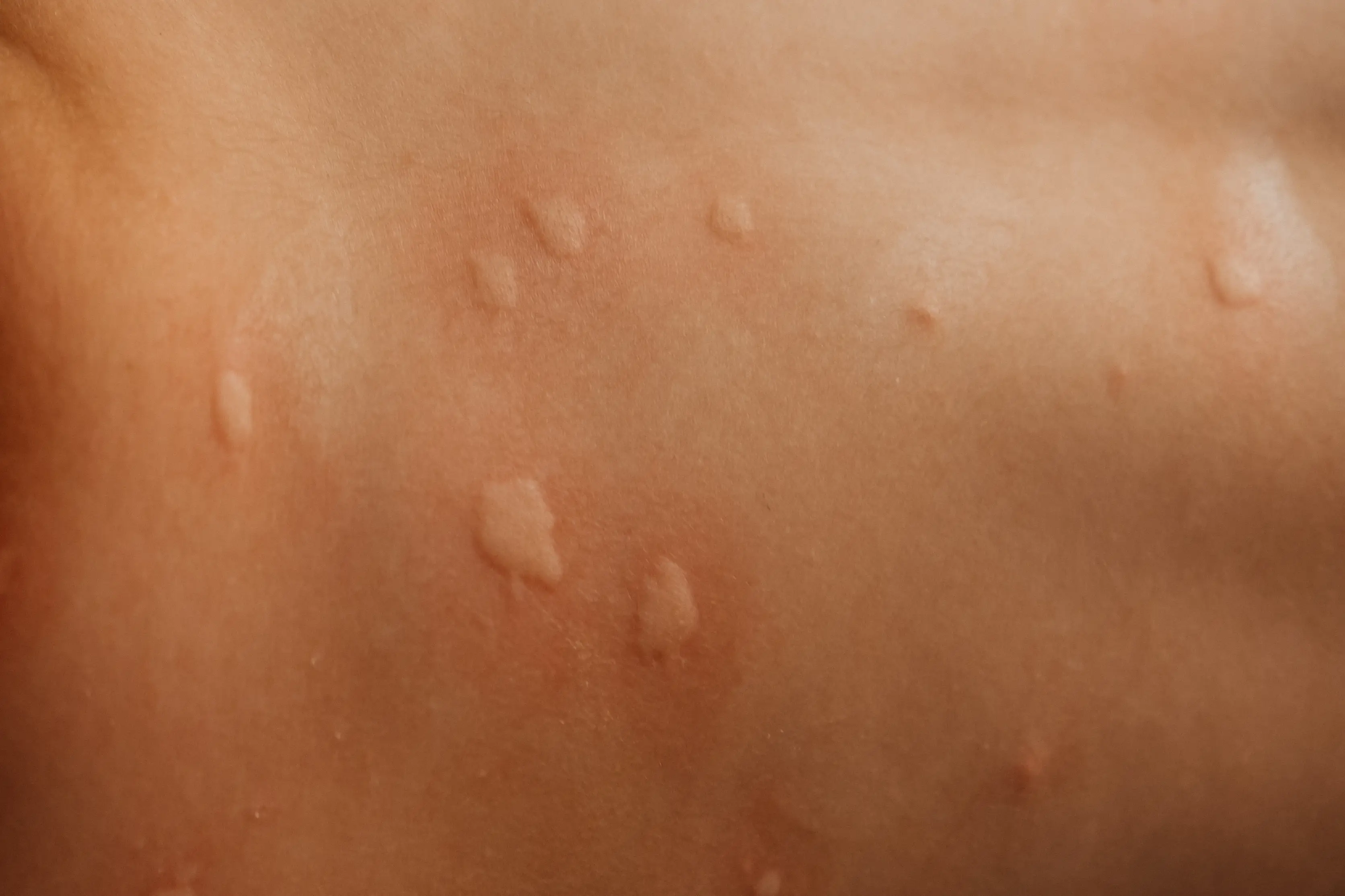 Symptoms present themselves from two to six hours after eating meat (Ekaterina Vasileva-Bagler/Getty Stock Image)