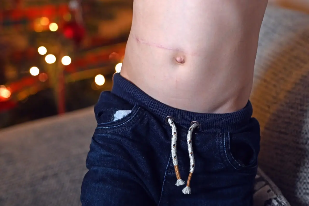 He had to have his appendix removed.