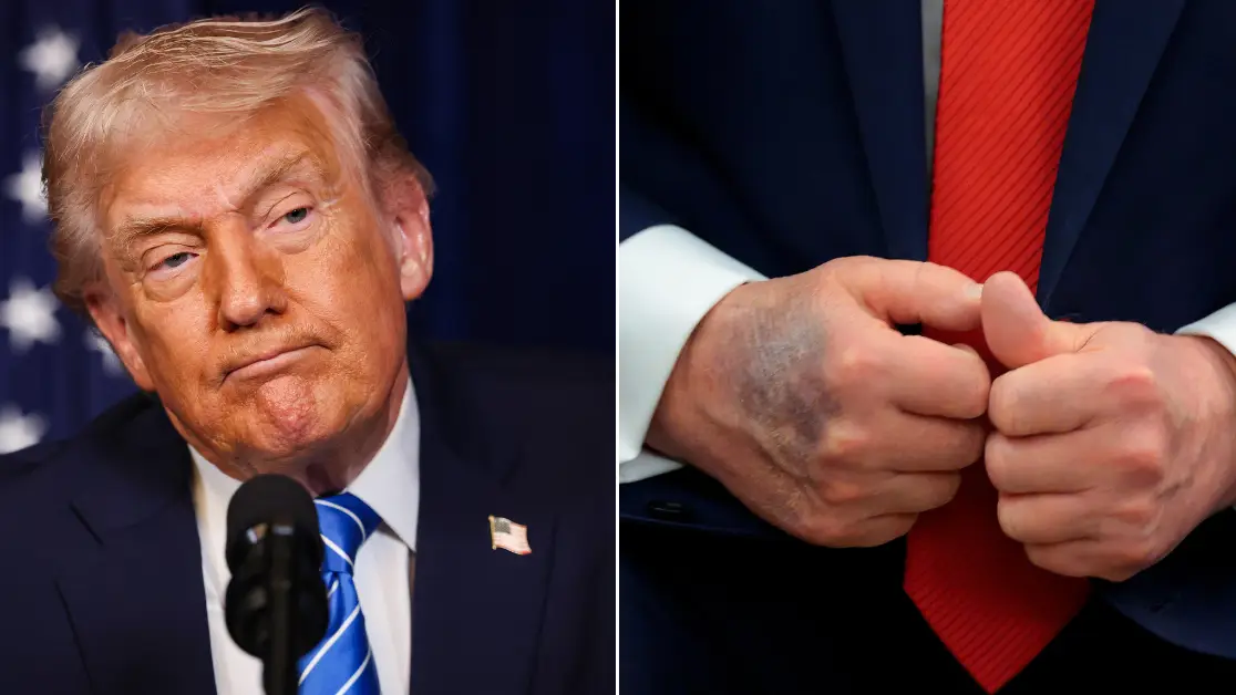 Donald Trump finally reveals 'real reason' his hands have been spotted with 'mystery mark'