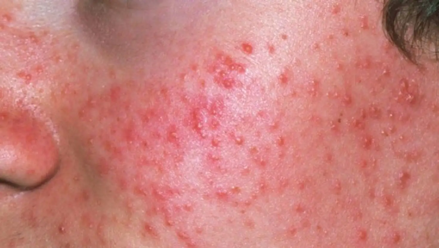 Sugary milk-based caffeine drinks could cause acne, an expert warned (NHS)