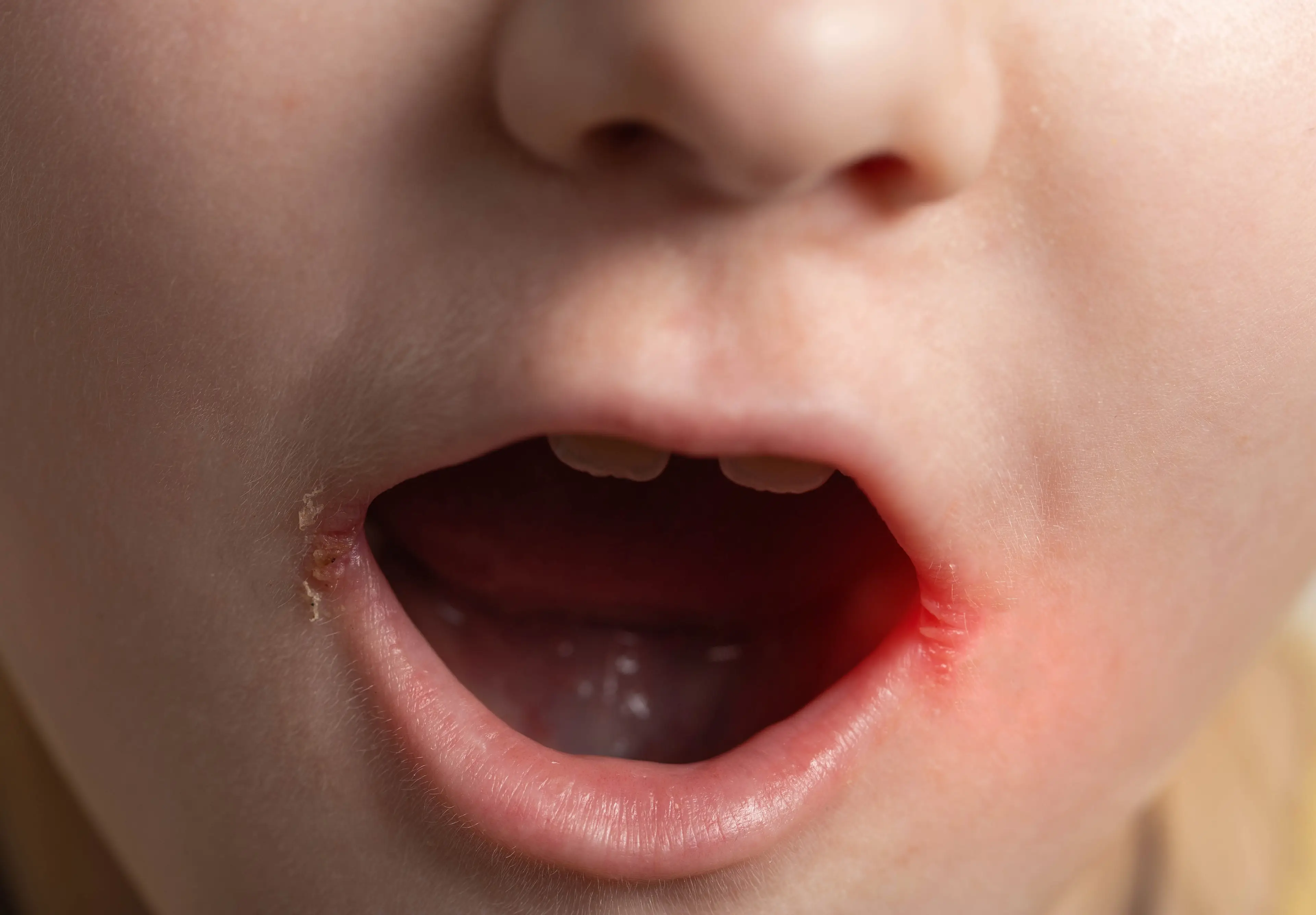 Lip balm may not help the problem (Getty Stock Image)