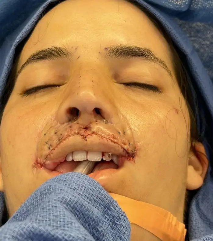 Brooklinn explained that her surgeon had 'recreated the central columns, the lip and the cupids bow'.