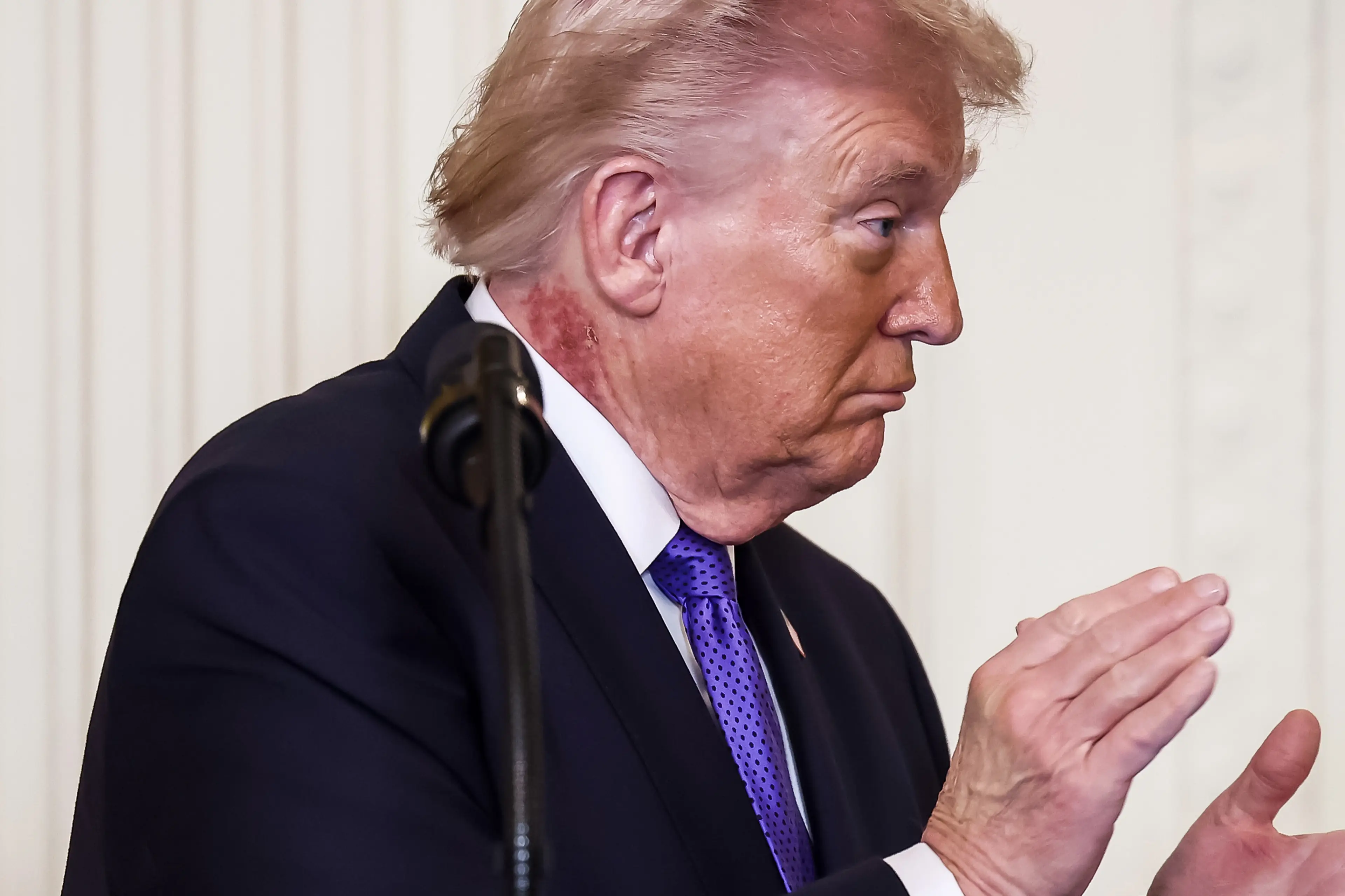 Trump's rash appeared during a Medal of Honour ceremony (Jim Lo Scalzo/EPA/Bloomberg via Getty Images)