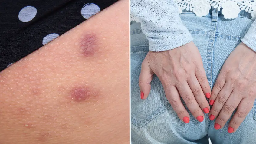 How to tell if your bum spots are actually an STI