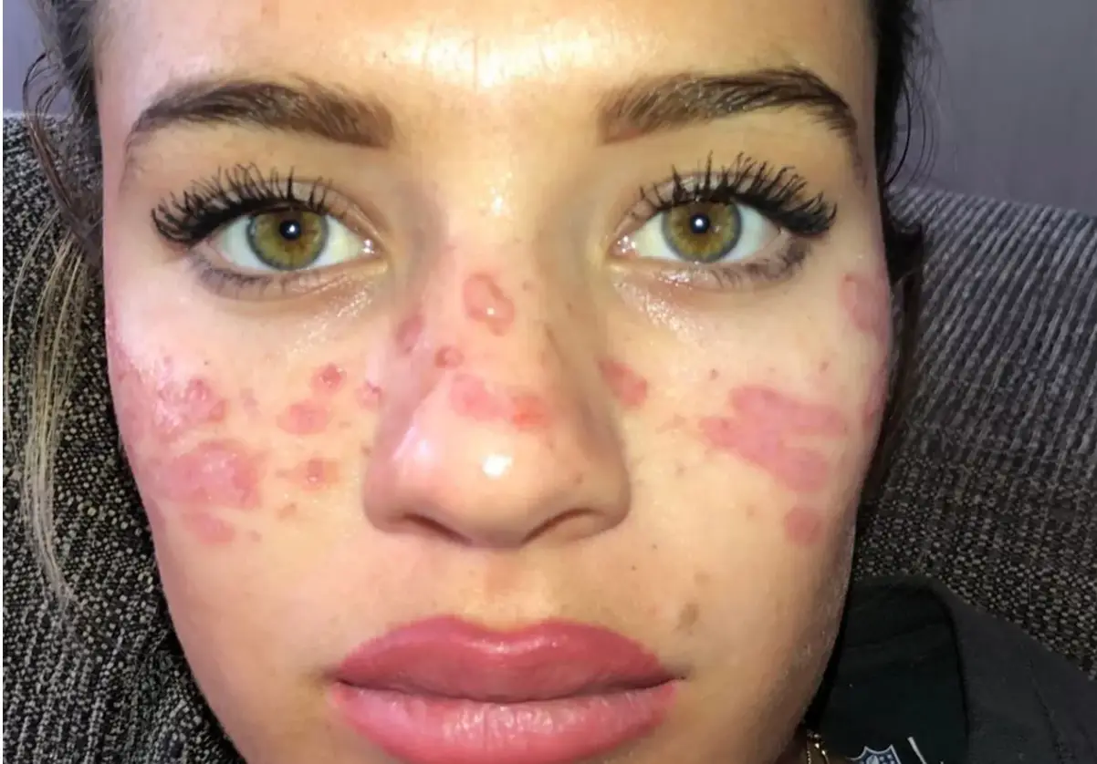 The influencer tried to do DIY freckles at home but it went badly wrong (Instagram/@tillywhitfield)