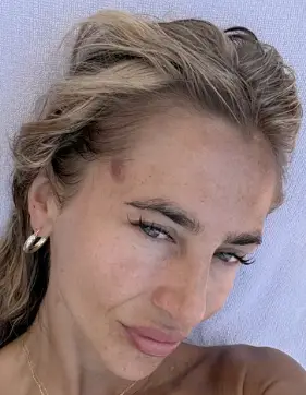 Beth noticed a red mark on the side of her forehead but thought it was eczema (ITV)