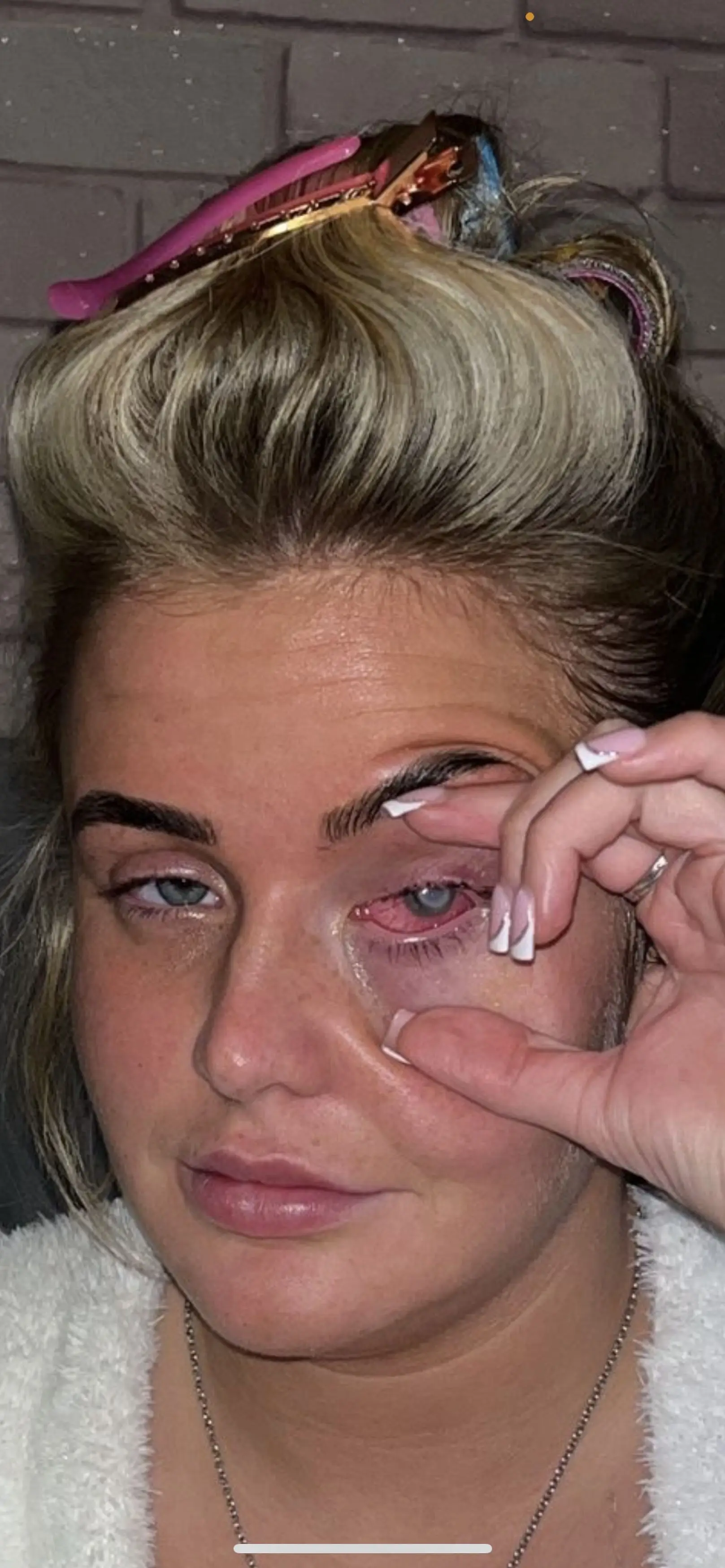 Lillie is now considering surgery. (Kennedy)