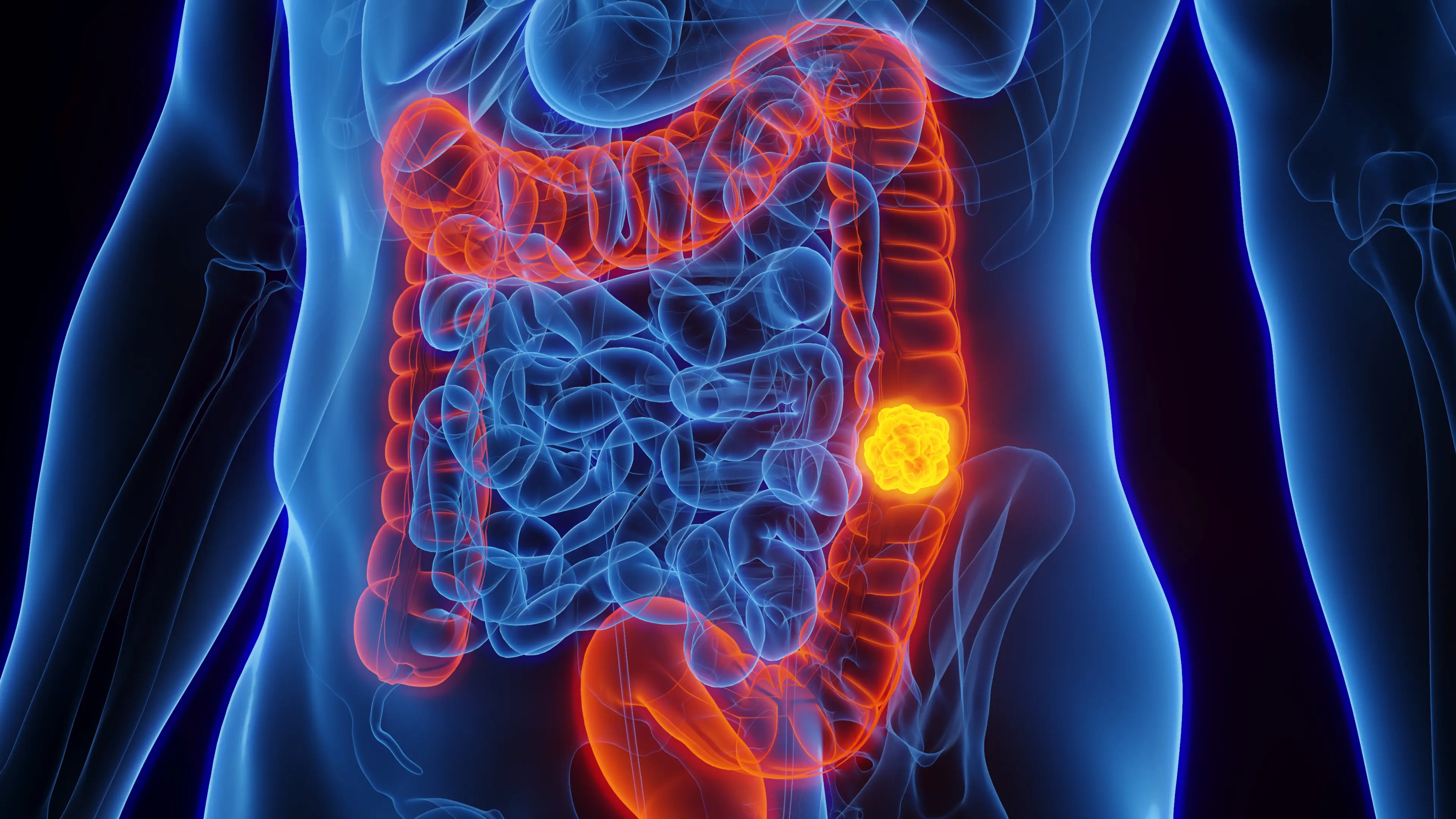 Woman with stage four colon cancer reveals five symptoms she initially dismissed