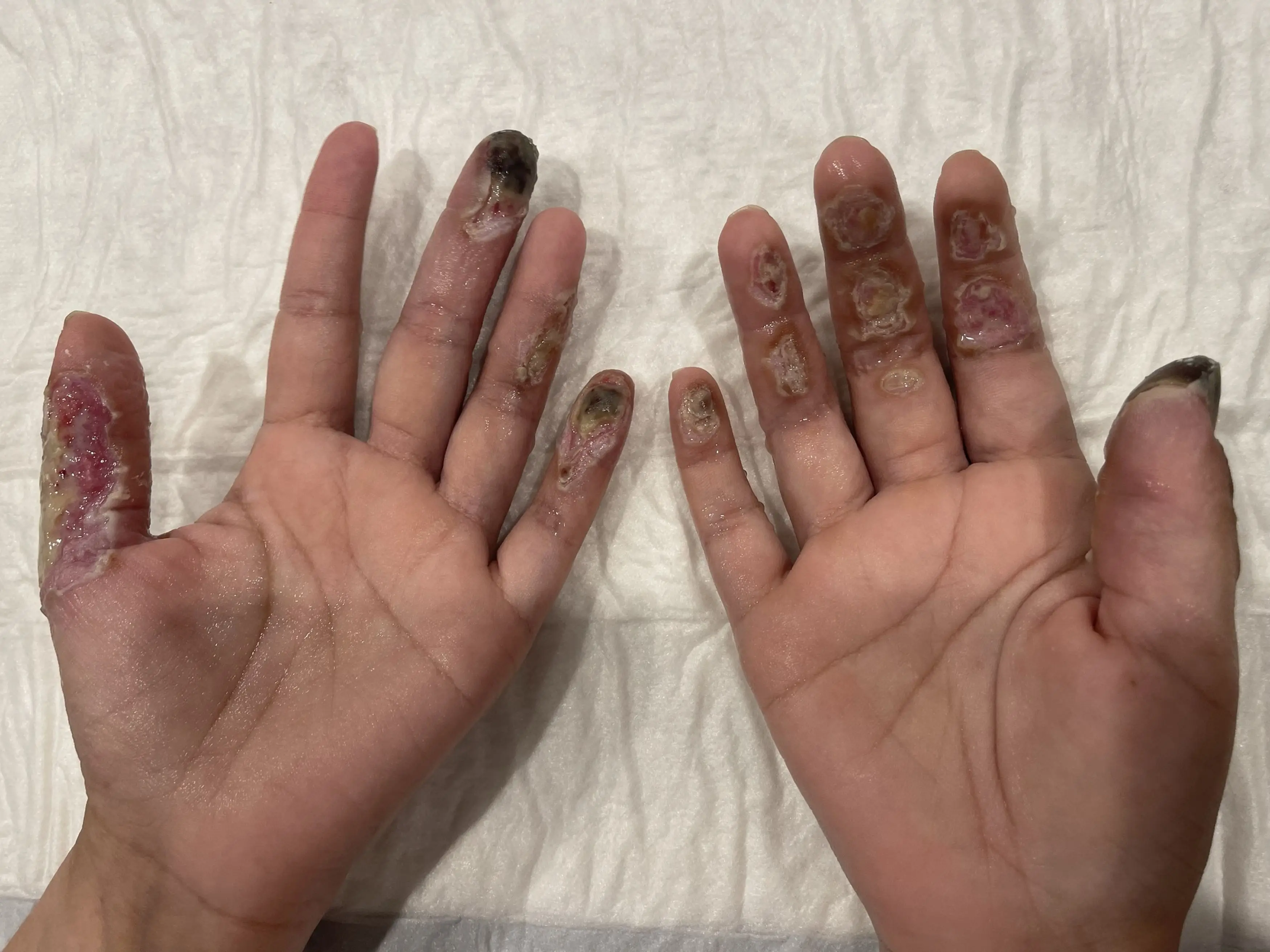 Shannyn's hands began to blister and burn following the surgery.