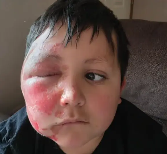 Caleb Chabolla, 9, was left with second-degree burns when one toy exploded in his face (CBS Chicago)