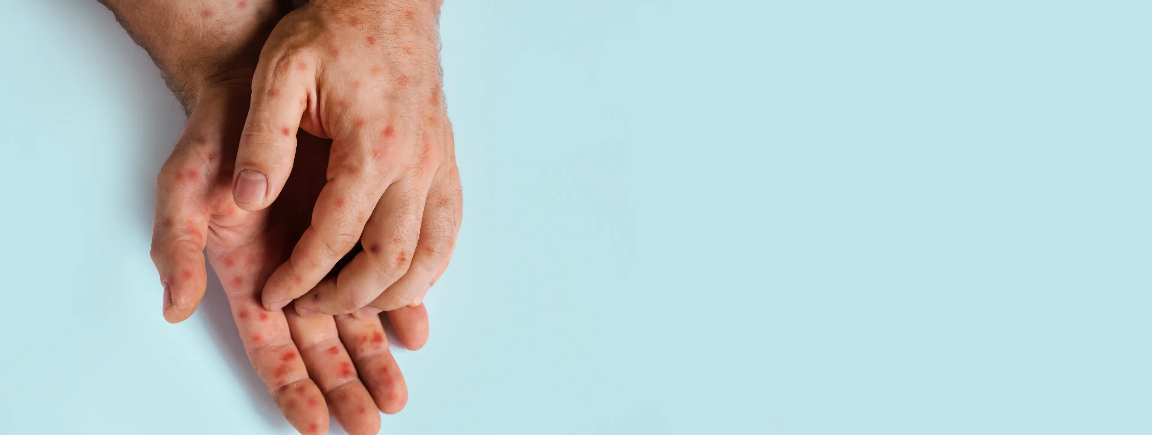 It can cause an uncomfortable rash. (Getty stock images)