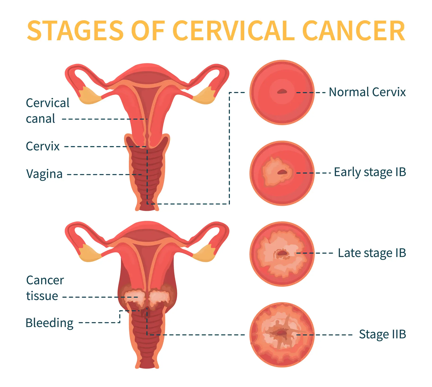 Cervical cancer has four main stages (Getty Stock Images)