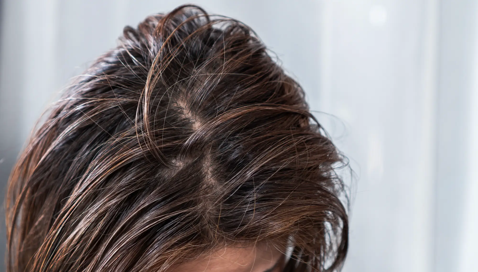 A doctor has issued a warning over a particularly oily scalp (Getty Stock Images)