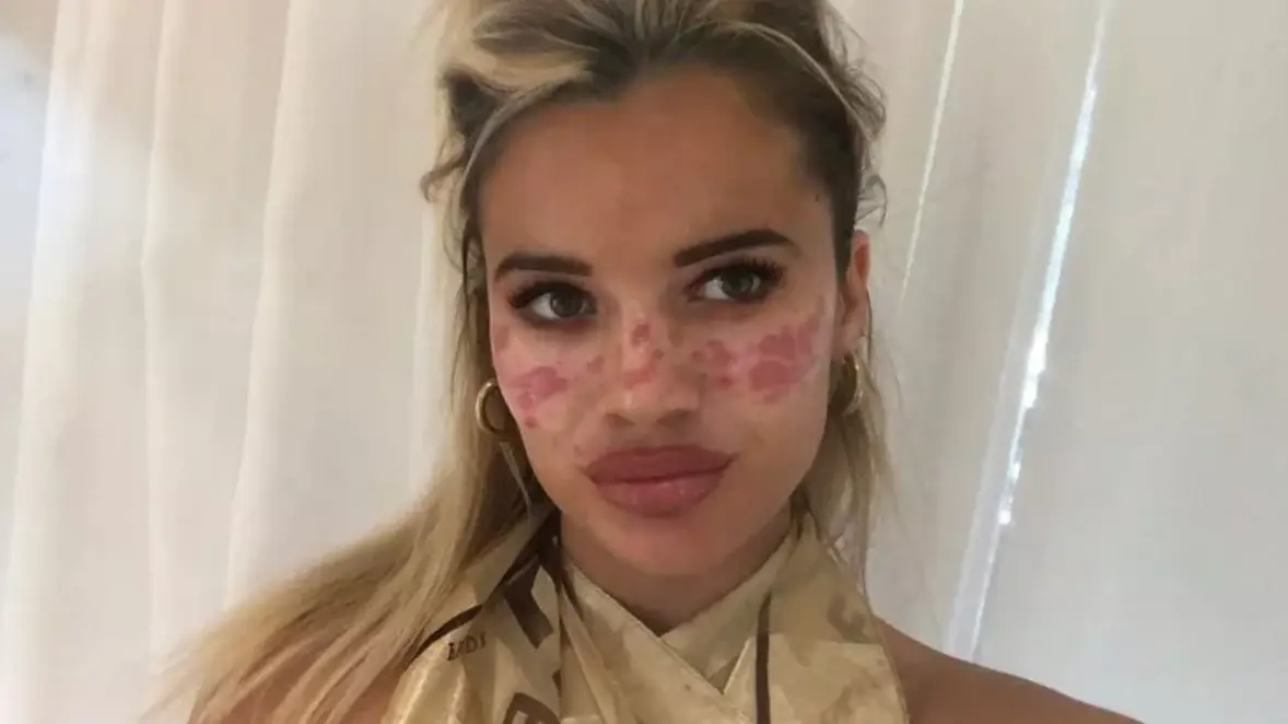 26-year-old influencer Tilly Whitfeld shares painful lesson after TikTok freckle trend left her disfigured