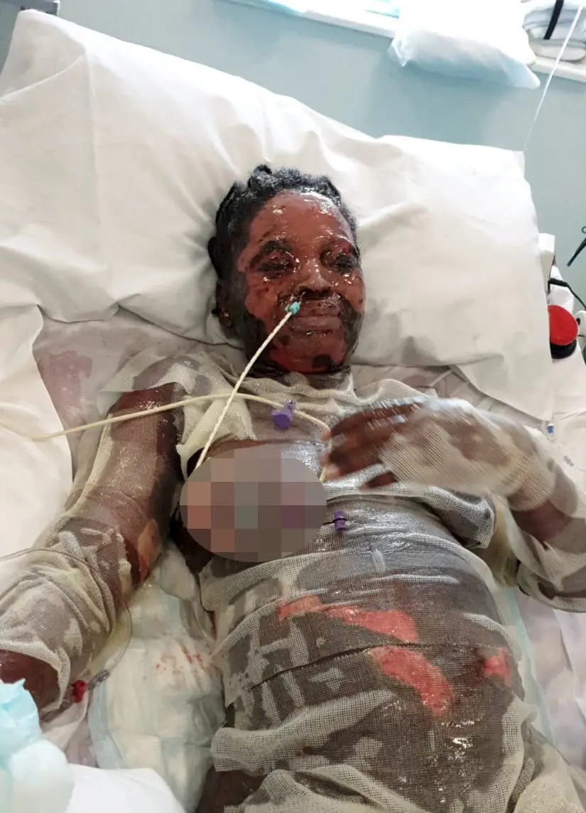 She suffered severe skin peeling.