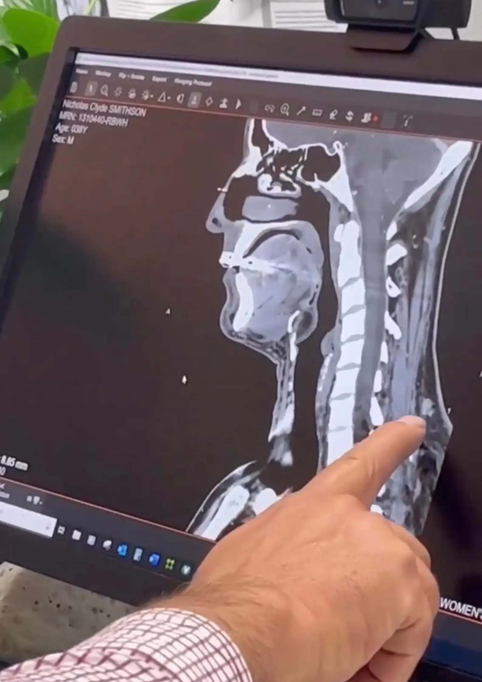 The lump at the back of Nicko's neck was a nodular melanoma.