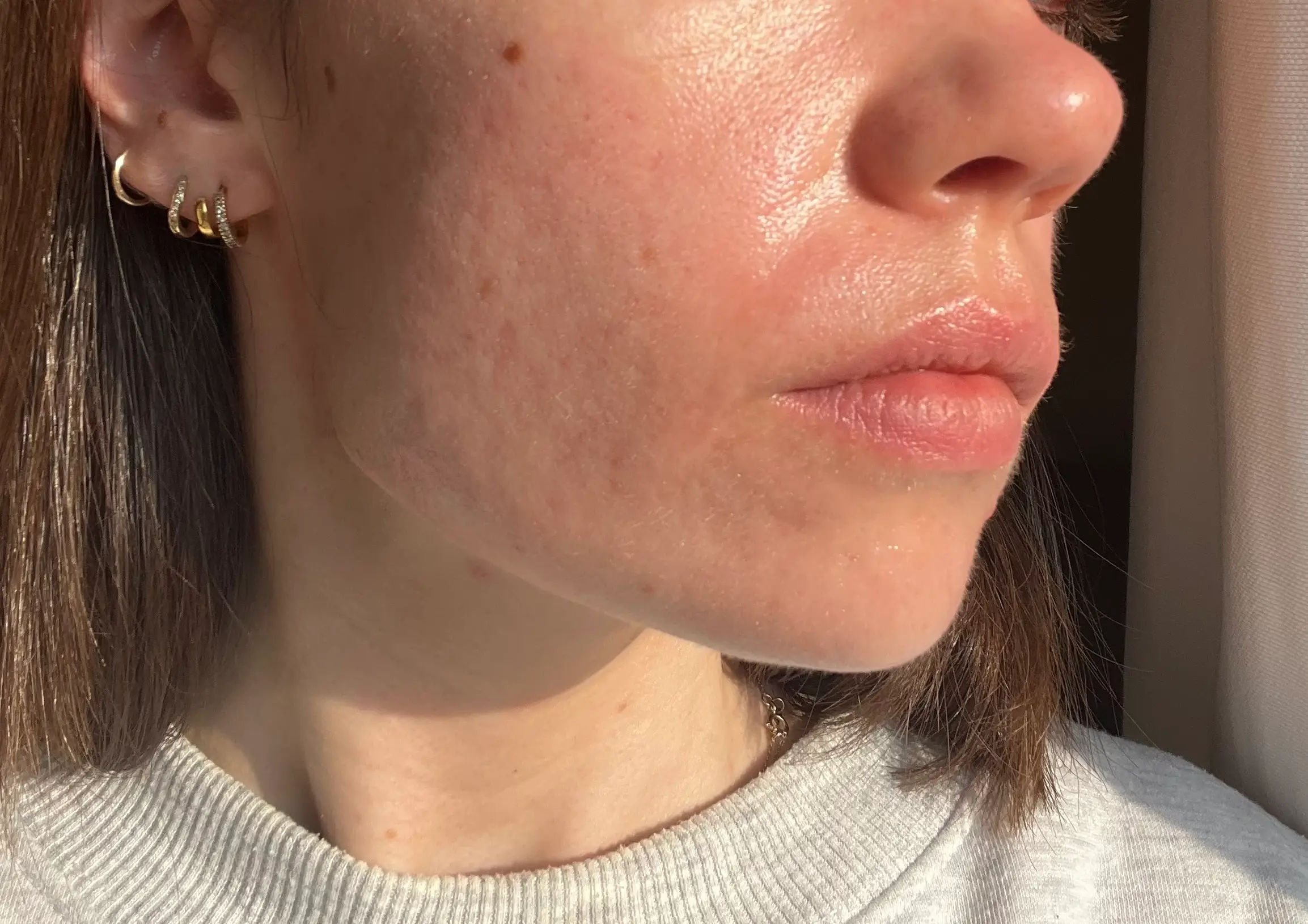 The moisturiser has also helped to reduce acne scars over the years 