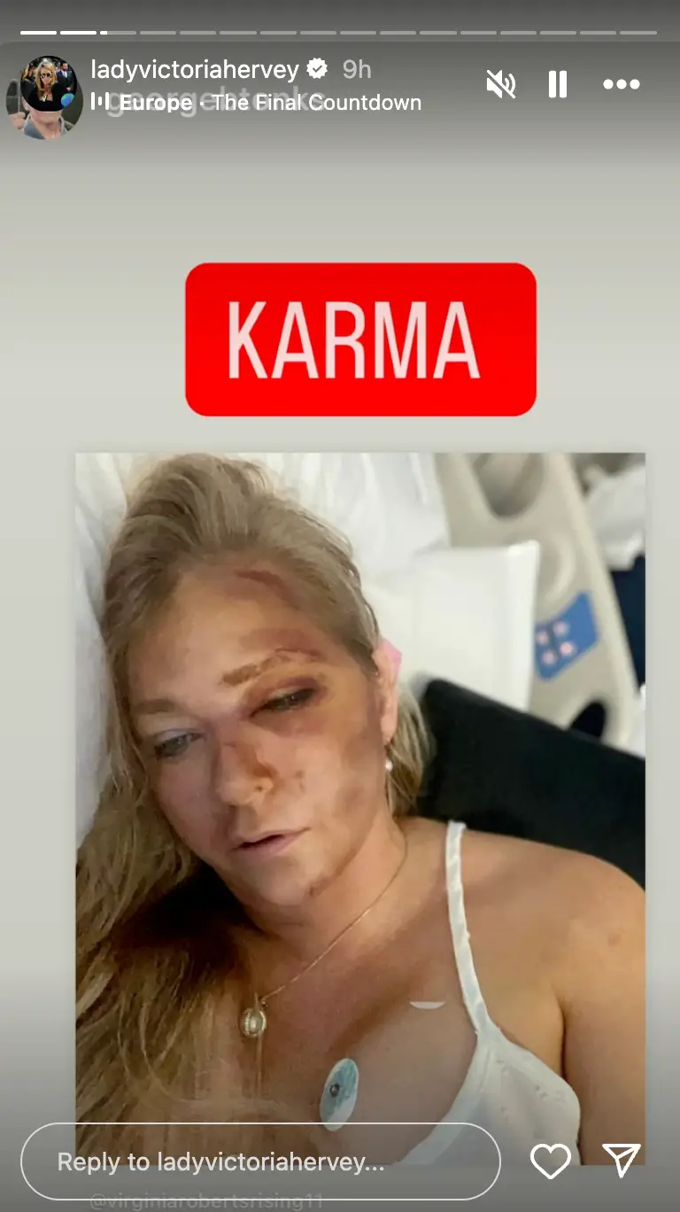 Hervey re-posted Giuffre's photo of her facial injuries with the words 'KARMA' plastered over it (Instagram/@ladyvictoriahervey)