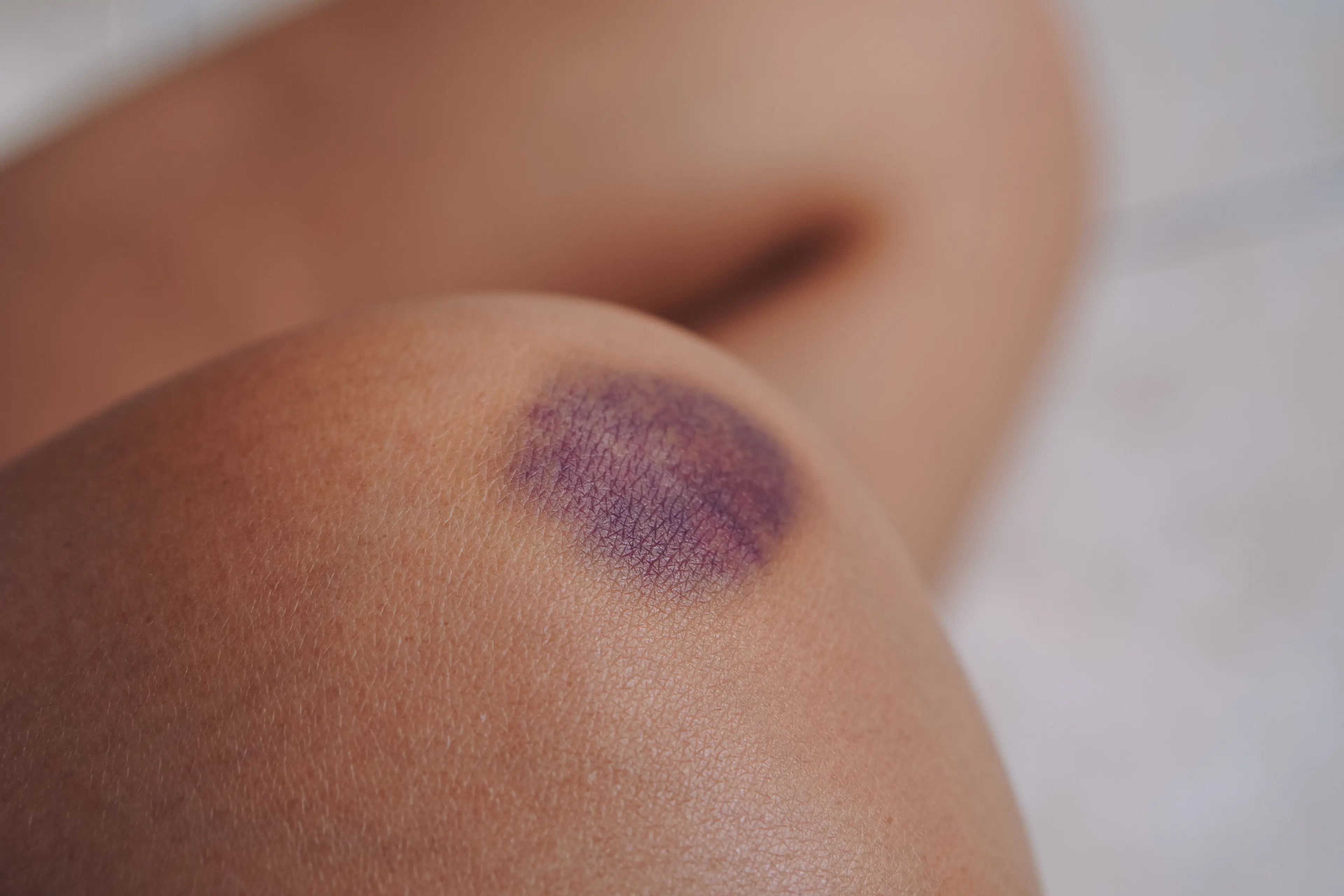 A similar bruise forms inside the mouth (Getty Stock Image)