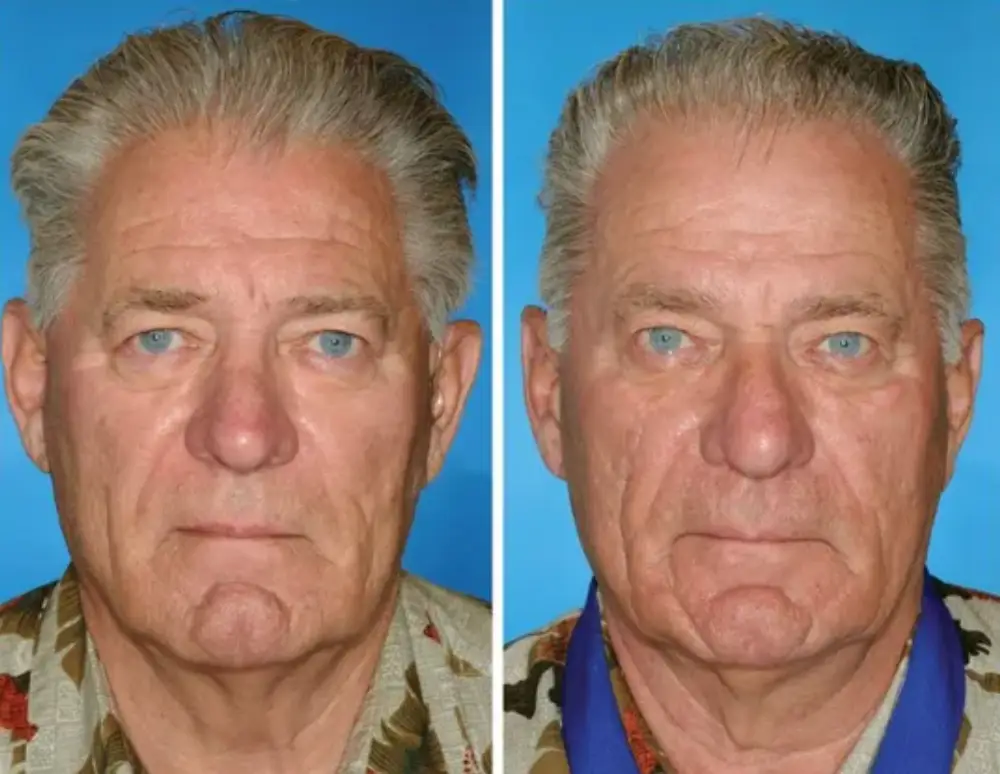 While both twins smoked, the twin on the right smoked 14 years longer than his brother (American Society of Plastic Surgeons)