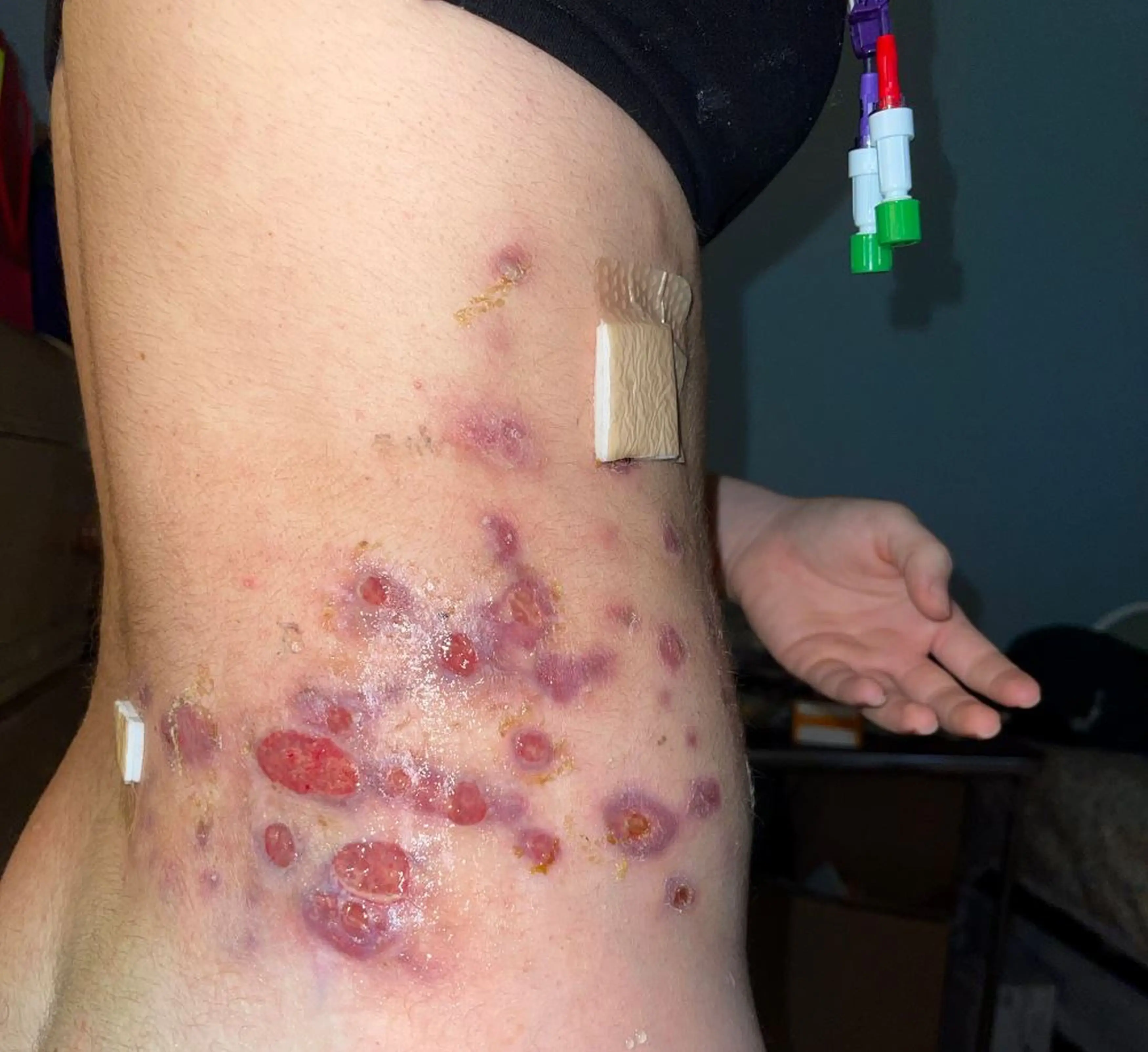 Beatriz's skin came up in 'welts'.