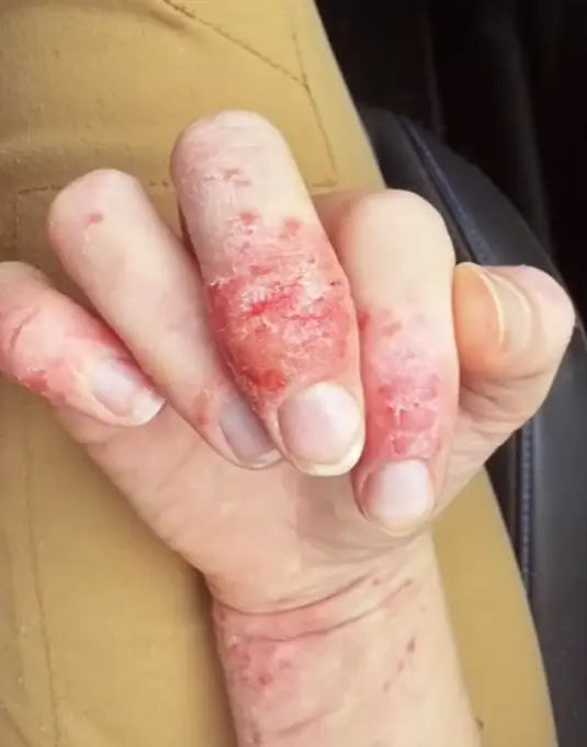 She said a crack in her skin nearly killed her (YouTube/ABC Science)