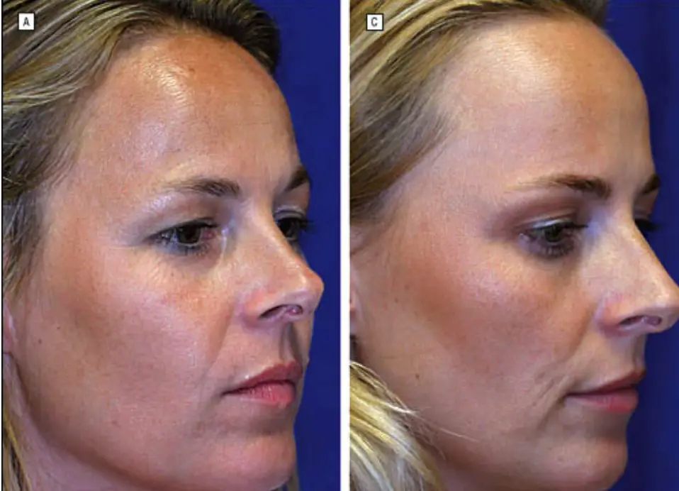 Lines were more evident around Twin 1's (left) eyes (American Society for Dermatologic Surgery)