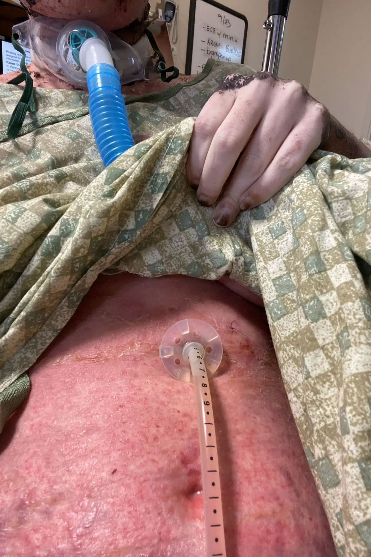 The Nebraska resident has issued a warning to other people who take the popular painkiller (Kennedy News)