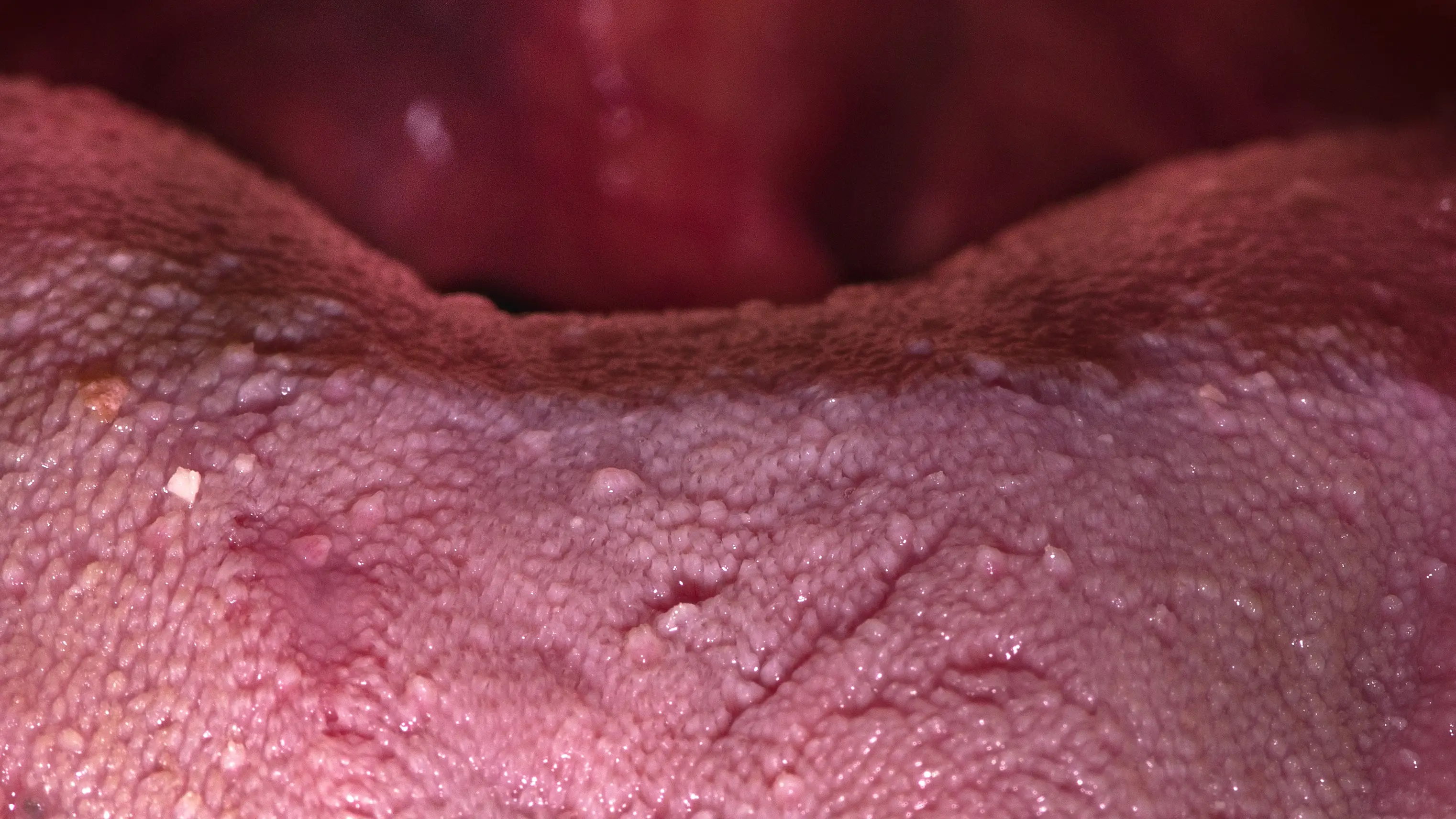 It's normal to have these bumps on your tongue (Norman Zeb/Getty)